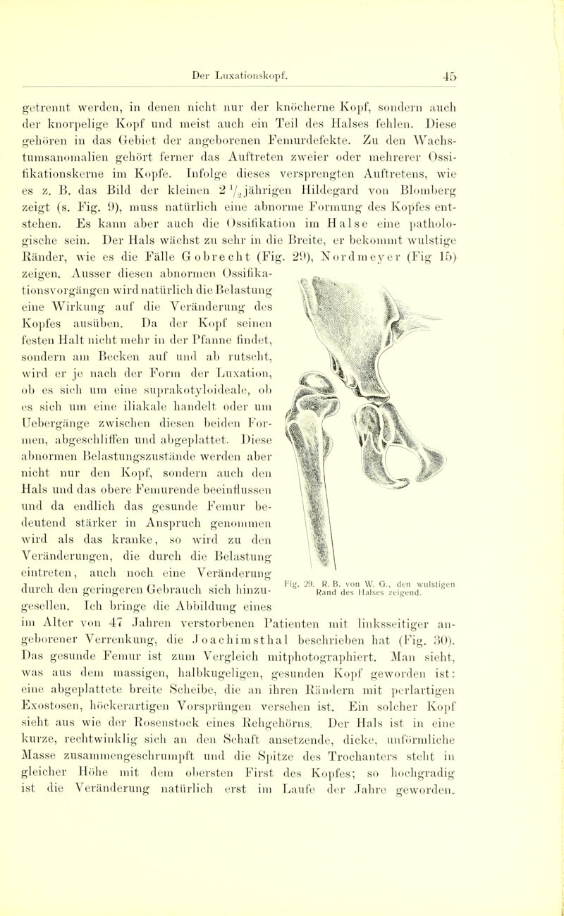 getrennt werden, in denen nicht nur der knöcherne Kopf, sondern auch der knorpelige Kopf und meist auch ein Teil des Halses fehlen. Diese gehören in das Gebiet der angeborenen Femurdefekte. Zu den Wachs- tumsanomalien gehört ferner das Auftreten zweier oder mehrerer Ossi- fikationskerne im Kopfe. Infolge dieses versprengten Auftretens, wie es z. B. das Bild der kleinen 2 '/„ jährigen Hildegard von Blomberg zeigt (s. Fig. 9), muss natürlich eine abnorme Formung des Kopfes ent- stehen. Es kann aber auch die Ossifikation im Halse eine patholo- gische sein. Der Hals wächst zu sehr in die Breite, er bekommt wulstige Ränder, wie es die Fälle G obre cht (Fig. 29), Nordmeyer (Fig 15) zeigen. Ausser diesen abnormen Ossihka- tionsvorgängen wird natürlich die Belastung eine Wirkung auf die Veränderung des Kopfes ausüben. Da der Kopf seinen festen Halt nicht mehr in der Pfanne findet, sondern am Becken auf und ab rutscht, wird er je nach der Form der Luxation, ob es sich um eine suprakotyloideale, ob es sich um eine iliakale handelt oder um Uebergänge zwischen diesen beiden For- men, abgeschliffen und altgeplattet. Diese abnormen Belastungszustände werden aber nicht nur den Kopf, sondern auch den Hals und das obere Femurende beeinflussen und da endlich das gesunde Femur be- deutend stärker in Anspruch genommen wird als das kranke, so wird zu den Veränderungen, die durch die Belastung eintreten, auch noch eine Veränderung durch den geringeren Gebrauch sich hinzu- gesellen. Ich bringe die Abbildung eines im Alter von 47 Jahren verstorbenen Patienten mit linksseitiger an- geborener Verrenkung, die Joachimsthal beschrieben hat (Fig. 30). Das gesunde Femur ist zum Vergleich mitphotographiert. Man sieht, was aus dem massigen, halbkugeligen, gesunden Kopf geworden ist: eine abgeplattete breite Scheibe, die an ihren Rändern mit perlartigen Exostosen, höckerartigen Vorsprüngen versehen ist. Ein solcher Kopf sieht aus wie der Rosenstock eines Rehgehörns. Der Hals ist in eine kurze, rechtwinklig sich an den Schaft ansetzende, dicke, unförmliche Masse zusammengeschrumpft und die Spitze des Trochanters steht in gleicher Höhe mit dem obersten First des Kopfes; so hochgradig ist die Veränderung natürlich erst im Laufe der Jahre geworden. Fig. 29. R. B. von W. G., den wulstigen Rand des Halses zeigend.