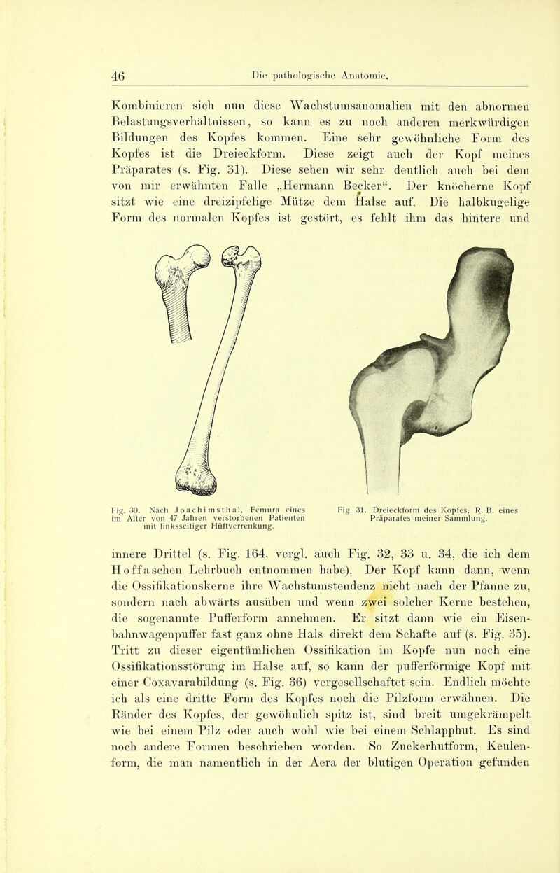 Kombinieren sich nun diese Wachstumsanomalien mit den abnormen Belastungsverhältnissen, so kann es zu noch anderen merkwürdigen Bildungen des Kopfes kommen. Eine sehr gewöhnliche Form des Kopfes ist die Dreieckform. Diese zeigt auch der Kopf meines Präparates (s. Fig. 31). Diese sehen wir sehr deutlich auch bei dem von mir erwähnten Falle „Hermann Becker. Der knöcherne Kopf sitzt wie eine dreizipfelige Mütze dem Halse auf. Die halbkugelige Form des normalen Kopfes ist gestört, es fehlt ihm das hintere und Fig. 30. Nach Joachimsthal. Femura eines Fig. 31. Dreieckform des Kopfes, R.B. eines im Alter von 47 Jahren verstorbenen Patienten Präparates meiner Sammlung, mit linksseitiger Hüftverrenkung. innere Drittel (s. Fig. 164, vergl. auch Fig. 32, 33 u. 34, die ich dem H o ffasehen Lehrbuch entnommen habe). Der Kopf kann dann, wenn die Ossifikationskerne ihre Wachstumstendenz nicht nach der Pfanne zu, sondern nach abwärts ausüben und wenn zwei solcher Kerne bestehen, die sogenannte Pufferform annehmen. Er sitzt dann wie ein Eisen- bahnwagenpuffer fast ganz ohne Hals direkt dem Schafte auf (s. Fig. 35). Tritt zu dieser eigentümlichen Ossifikation im Kopfe nun noch eine Ossifikationsstörung im Halse auf, so kann der pufferförmige Kopf mit einer Coxavarabildung (s. Fig. 36) vergesellschaftet sein. Endlich möchte ich als eine dritte Form des Kopfes noch die Pilzform erwähnen. Die Ränder des Kopfes, der gewöhnlich spitz ist, sind breit umgekrämpelt wie bei einem Pilz oder auch wohl wie bei einem Schlapphut. Es sind noch andere Formen beschrieben worden. So Zuckerhutform, Keulen- form, die man namentlich in der Aera der blutigen Operation gefunden