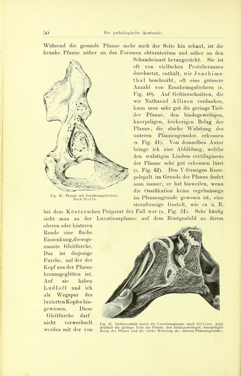 Während die gesunde Pfanne mehr nach der Seite hin schaut, ist die kranke Pfanne näher an das Foramen obturatorium und näher an den Schambeinast herangerückt. Sie ist oft von vielfachen Piotuberanzen durchsetzt, enthält, wie Joachims- thal beschreibt, oft eine grössere Anzahl von Ernährungslöchern (s. Fig. 40). Auf Gefrierschnitten, die wir Nathaniel Allison verdanken, kann man sehr gut die geringe Tiefe der Pfanne, den bindegewebigen, knorpeligen, höckerigen Belag der Pfanne, die starke Wulstung des unteren Pfannengrundes. erkennen (s. Fig. 41). . Von demselben Autor bringe ich eine Abbildung, welche den wulstigen Limbus cartilagineus der Pfanne sehr gut erkennen lässt (s. Fig. 42). Den Y-fönnigen Knor- •']h'f'<<vjfi pelspalt im Grunde der Pfanne findet man immer; er hat bisweilen, wenn die Ossifikation keine regelmässige im Pfannengrunde gewesen ist, eine sternförmige Gestalt, wie es z. B. bei dem Köster sehen Präparat der Fall war (s. Fig. 31). Sehr häufig sieht man an der Luxationspfanne auf dem Röntgenbild an ihrem oberen oder hinteren Rande eine flache Einsenkung,diesoge- nannte Gleitfurche. Das ist diejenige Furche, auf der der Kopf aus der Pfanne herausgeglitten ist. Auf sie haben Ludloff und ich als Wegspur des luxiertenKopfes hin- gewiesen. Diese Gleitfurche darf nicht verwechselt [?ig. 41. Gefrierschnitt durch die Luxationspfanne nach Allison, zeigt 1 • 1 i deutlich die geringe Tiefe der Pfanne, den bindegewebigen, knorpeligen Werden mit der VOn Belag der Pfanne und die starke Wulstung des unteren Pfannengrundes. Fig. 40. Pfanne mit Ernahrungslöchern. Nach Hoffa.