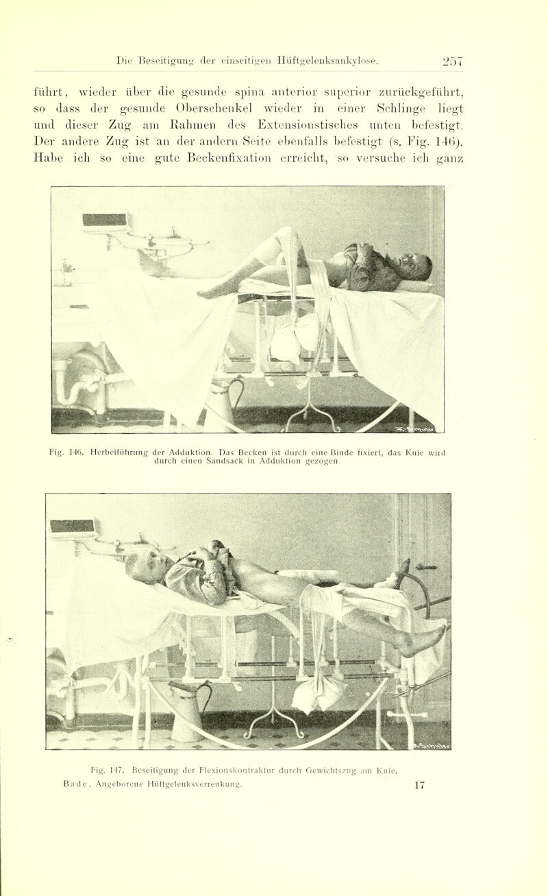 führt, wieder über die gesunde spina anterior superior zurückgeführt, so dass der gesunde Oberschenkel wieder in einer Schlinge liegt und dieser Zug am Rahmen des Extensionstisches unten befestigt. Der andere Zug ist an der andern Seite ebenfalls befestigt (s. Fig. 146). Habe ich so eine gute Beckenfixation erreicht, so versuche ich ganz Fig. 146. Herbeiführung der Aiiduktion. Das Becken ist durch eine Binde fixiert, das Knie wild durch einen Sandsack in Adduktion gezogen. Fig. 147. Beseitigung der Flexionskontraktur durch Gewichtszug am Knie. Bade, Angeborene Hüftgelenksverrenkung. 17