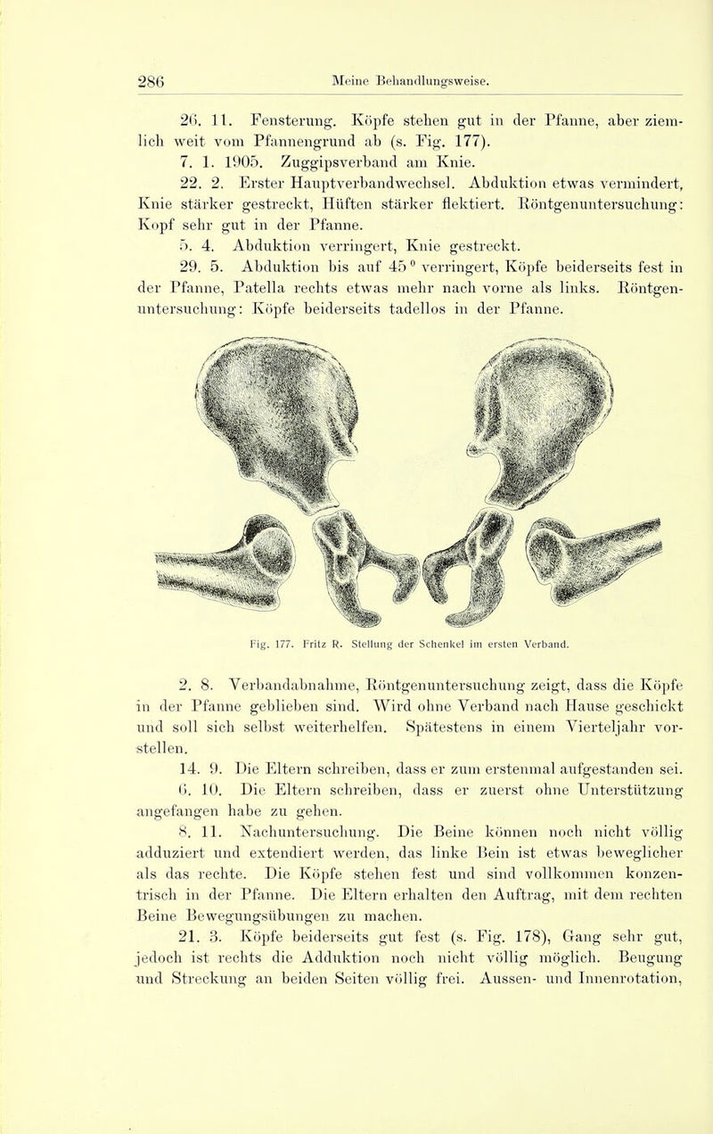 26. 11. Fensterung. Köpfe stehen gut in der Pfanne, aber ziem- lich weit vom Pfannengrund ab (s. Fig. 177). 7. 1. 1905. Zuggipsverband am Knie. 22. 2. Erster Hauptverbandwechsel. Abduktion etwas vermindert, Knie stärker gestreckt, Hüften stärker flektiert. Röntgenuntersuchung: Kopf sehr gut in der Pfanne. 5. 4. Abduktion verringert, Knie gestreckt. 29. 5. Abduktion bis auf 45 0 verringert, Köpfe beiderseits fest in der Pfanne, Patella rechts etwas mehr nach vorne als links. Röntgen- untersuchung: Köpfe beiderseits tadellos in der Pfanne. Fig. 177. Fritz R. Stellung der Schenkel im ersten Verband. 2. 8. Verbandabnahme, Röntgenuntersuchung zeigt, dass die Köpfe in der Pfanne geblieben sind. Wird ohne Verband nach Hause geschickt und soll sich selbst weiterhelfen. Spätestens in einem Vierteljahr vor- stellen. 14. 9. Die Eltern schreiben, dass er zum erstenmal aufgestanden sei. 6. 10. Die Eltern schreiben, dass er zuerst ohne Unterstützung angefangen habe zu gehen. 8. 11. Nachuntersuchung. Die Beine können noch nicht völlig adduziert und extendiert werden, das linke Bein ist etwas beweglicher als das rechte. Die Köpfe stehen fest und sind vollkommen konzen- trisch in der Pfanne. Die Eltern erhalten den Auftrag, mit dem rechten Beine Bewegungsübungen zu machen. 21. 3. Köpfe beiderseits gut fest (s. Fig. 178), Gang sehr gut, jedoch ist rechts die Adduktion noch nicht völlig möglich. Beugung und Streckung an beiden Seiten völlig frei. Aussen- und Innenrotation,