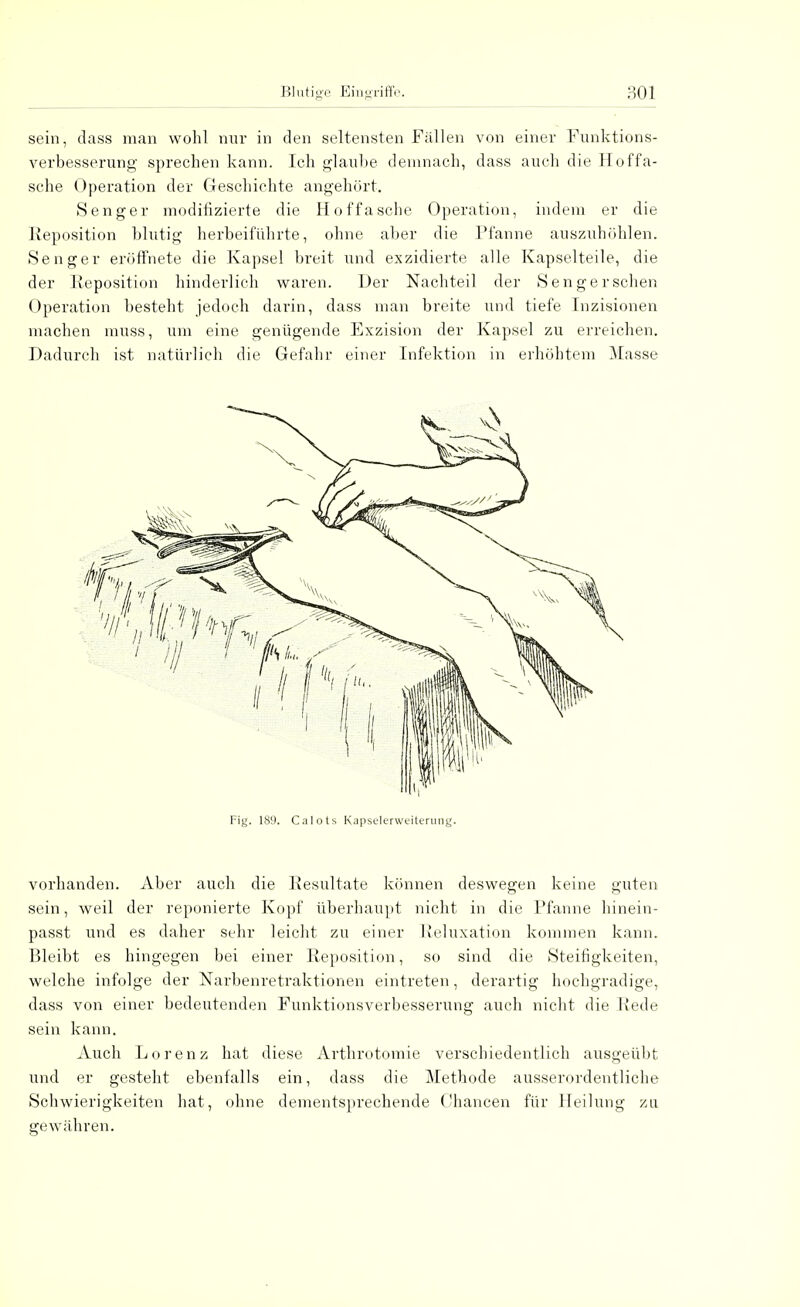 sein, dass man wohl nur in den seltensten Fällen von einer Funktions- verbesserung sprechen kann. Ich glaube demnach, dass auch die Hoffa- sche Operation der Geschichte angehört. Senger modifizierte die Hoffasche Operation, indem er die Reposition blutig herbeiführte, ohne aber die Pfanne auszuhöhlen. Senger eröffnete die Kapsel breit und exzidierte alle Kapselteile, die der Reposition hinderlich waren. Der Nachteil der Senger sehen Operation besteht jedoch darin, dass man breite und tiefe Inzisionen machen muss, um eine genügende Exzision der Kapsel zu erreichen. Dadurch ist natürlich die Gefahr einer Infektion in erhöhtem Masse Fig. 189. Calots Kapselerweiterung. vorhanden. Aber auch die Resultate können deswegen keine guten sein, weil der reponierte Kopf überhaupt nicht in die Pfanne hinein- passt und es daher sehr leicht zu einer Reluxation kommen kann. Bleibt es hingegen bei einer Reposition, so sind die Steifigkeiten, welche infolge der Narbenretraktionen eintreten, derartig hochgradige, dass von einer bedeutenden Funktionsverbesserung auch nicht die Rede sein kann. Auch Lorenz hat diese Arthrotomie verschiedentlich ausgeübt und er gesteht ebenfalls ein, dass die Methode ausserordentliche Schwierigkeiten hat, ohne dementsprechende Chancen für Heilung zu gewähren.