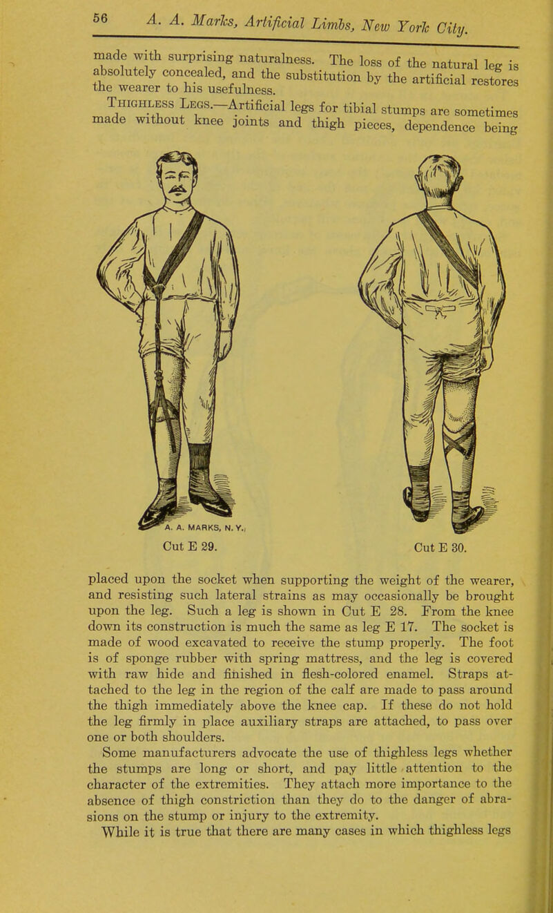 made with surprising naturalness. The loss of the natural leg is absolutely concealed and the substitution by the artificial restores the wearer to his usefulness. * quires Thighless LEGS—Artifieial legs for tibial stumps are sometimes made without knee joints and thigh pieces, dependence being . A. MARKS, N. Y.i Cut E 29. Cut E 30. placed upon the socket when supporting the weight of the wearer, and resisting such lateral strains as may occasionally be brought upon the leg. Such a leg is shown in Cut E 28. From the knee down its construction is much the same as leg E 17. The socket is made of wood excavated to receive the stump properly. The foot is of sponge rubber with spring mattress, and the leg is covered with raw hide and finished in flesh-colored enamel. Straps at- tached to the leg in the region of the calf are made to pass around the thigh immediately above the knee cap. If these do not hold the leg firmly in place auxiliary straps are attached, to pass over one or both shoulders. Some manufacturers advocate the use of thighless legs whether the stumps are long or short, and pay little attention to the character of the extremities. They attach more importance to the absence of thigh constriction than they do to the danger of abra- sions on the stump or injury to the extremity. While it is true that there are many cases in which thighless legs