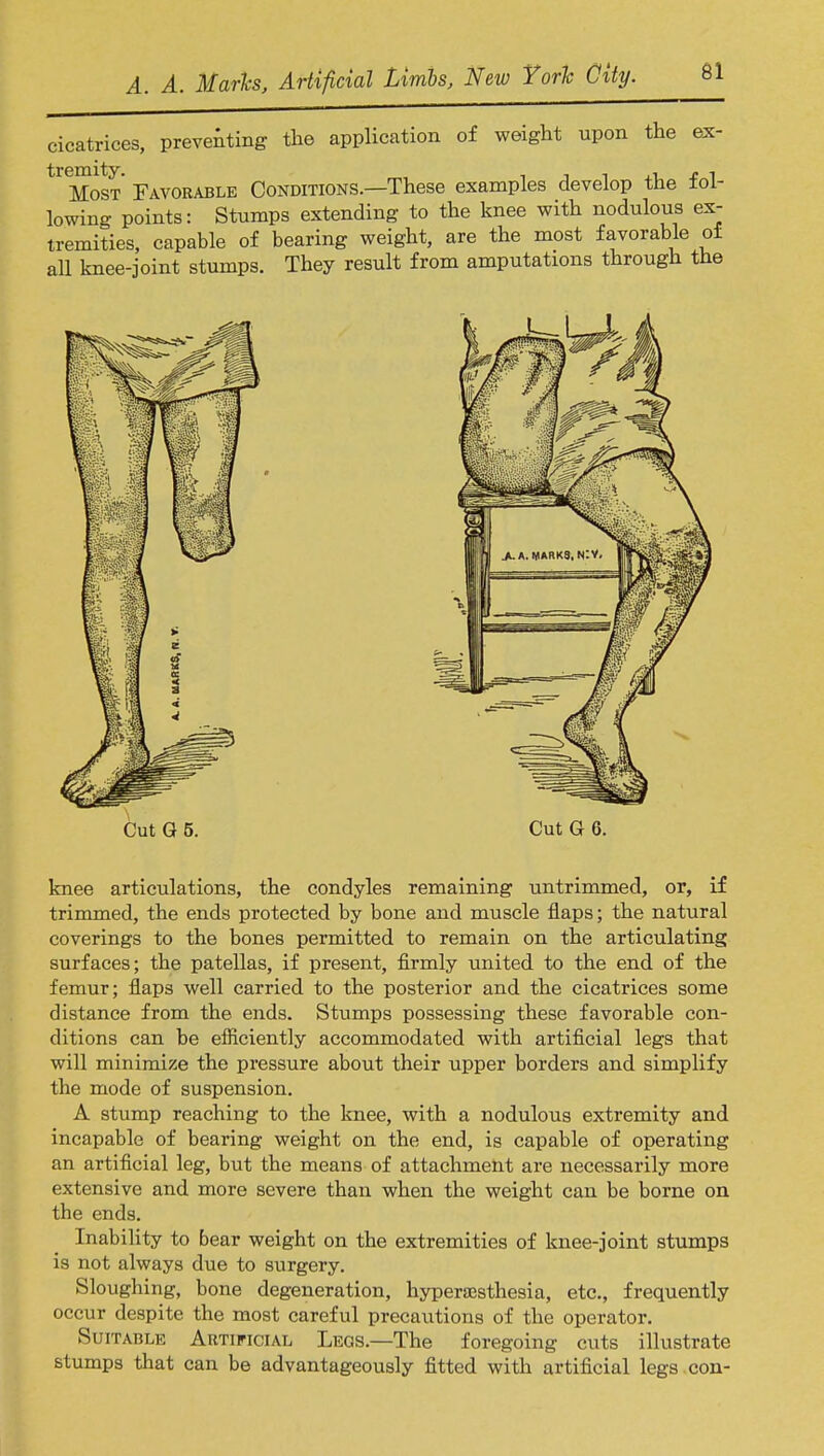 cicatrices, preventing the application of weight upon the ex- ^Tost Favorable Conditions.—These examples develop the fol- lowing points: Stumps extending to the knee with nodulous ex- tremities, capable of bearing weight, are the most favorable of all knee-joint stumps. They result from amputations through trie Cut G 5. Cut G 6. knee articulations, the condyles remaining untrimmed, or, if trimmed, the ends protected by bone and muscle flaps; the natural coverings to the bones permitted to remain on the articulating surfaces; the patellas, if present, firmly united to the end of the femur; flaps well carried to the posterior and the cicatrices some distance from the ends. Stumps possessing these favorable con- ditions can be efficiently accommodated with artificial legs that will minimize the pressure about their upper borders and simplify the mode of suspension. A stump reaching to the knee, with a nodulous extremity and incapable of bearing weight on the end, is capable of operating an artificial leg, but the means of attachment are necessarily more extensive and more severe than when the weight can be borne on the ends. Inability to bear weight on the extremities of knee-joint stumps is not always due to surgery. Sloughing, bone degeneration, hyperesthesia, etc., frequently occur despite the most careful precautions of the operator. Suitable Artificial Legs.—The foregoing cuts illustrate stumps that can be advantageously fitted with artificial legs con-