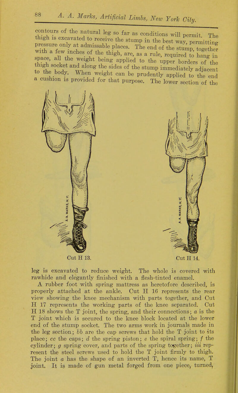 contours of the natural leg so far as conditions will permit The thigh is excavated.to receive the stump in the best way, permitting pressure only at admissable places. The end of the stump, t?geZr with a few inches of the thigh, are, as a rule, required to hangln tWn\ I J61^' aPPli6d t0 tte ^ Orders 7t £ t I f a^l0ng the Sid6S °f the StumP immediately adjacent to the body. When weight can be prudently applied to the end a cushion is provided for that purpose. The lower section of the Cut H 13. Cut H 14. leg is excavated to reduce weight. The whole is covered with rawhide and elegantly finished with a flesh-tinted enamel. A rubber foot with spring mattress as heretofore described, is properly attached at the ankle. Cut H 16 represents the rear view showing the knee mechanism with parts together, and Cut H 17 represents the working parts of the knee separated. Cut H 18 shows the T joint, the spring, and their connections; a is the T joint which is secured to the knee block located at the lower end of the stump socket. The two arms work in journals made in the leg section; bb are the cap screws that hold the T joint to its place; cc the caps; d the spring piston; e the spiral spring; f the cylinder; g spring cover, and parts of the spring together; Hi rep- resent the steel screws used to hold the T joint firmly to thigh. The joint a has the shape of an inverted T, hence its name, T joint. It is made of gun metal forged from one piece, turned.