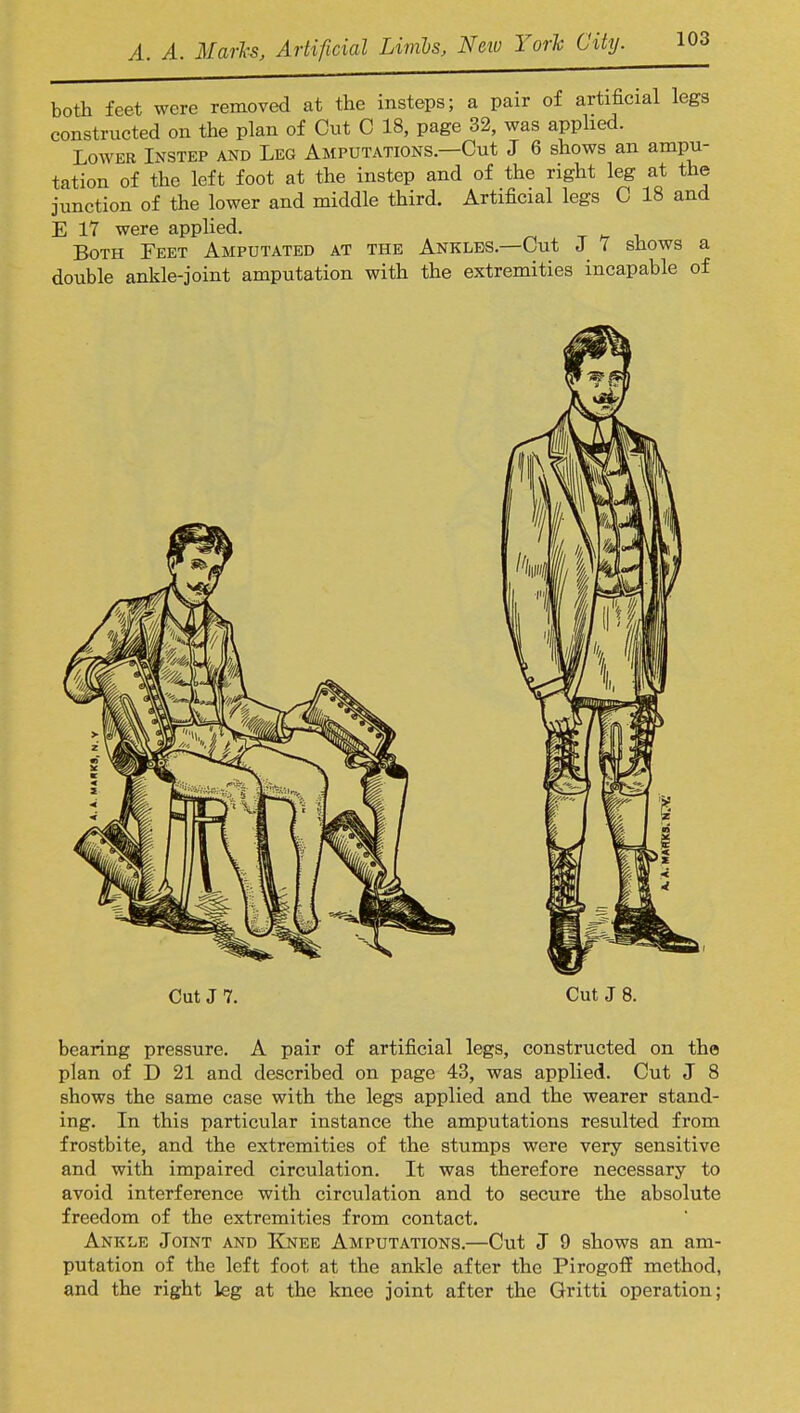 both feet were removed at the insteps; a pair of artificial legs constructed on the plan of Cut C 18, page 32, was applied. Lower Instep and Leg Amputations.—Cut J 6 shows an ampu- tation of the left foot at the instep and of the right leg at the junction of the lower and middle third. Artificial legs C 18 and E 17 were applied. Both Feet Amputated at the Ankles.—Cut J 7 shows a double ankle-joint amputation with the extremities incapable of Cut J 7. Cut J 8. bearing pressure. A pair of artificial legs, constructed on the plan of D 21 and described on page 43, was applied. Cut J 8 shows the same case with the legs applied and the wearer stand- ing. In this particular instance the amputations resulted from frostbite, and the extremities of the stumps were very sensitive and with impaired circulation. It was therefore necessary to avoid interference with circulation and to secure the absolute freedom of the extremities from contact. Ankle Joint and Knee Amputations.—Cut J 9 shows an am- putation of the left foot at the ankle after the Pirogoff method, and the right leg at the knee joint after the Gritti operation;