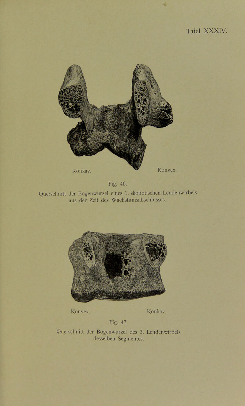 Fig. 46. Querschnitt der Bogenwurzel eines 1. skoliotischen Lendenwirbels aus der Zeit des Wachstumsabschlusses. Konvex. Konkav. Fig. 47. Querschnitt der Bogenwurzel des 3. Lendenwirbels desselben Segmentes.