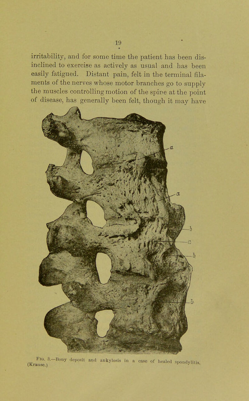 • irritability, and for some time the patient has been dis- inclined to exercise as actively as usual and has been easily fatigued. Distant pain, felt in the terminal fila- ments of the nerves whose motor branches go to supply the muscles controlling motion of the spine at the point of disease, has generally been felt, though it may have I. 3.-Bony deposit and ank.. , . - ... . .a., of healed spondyliti:
