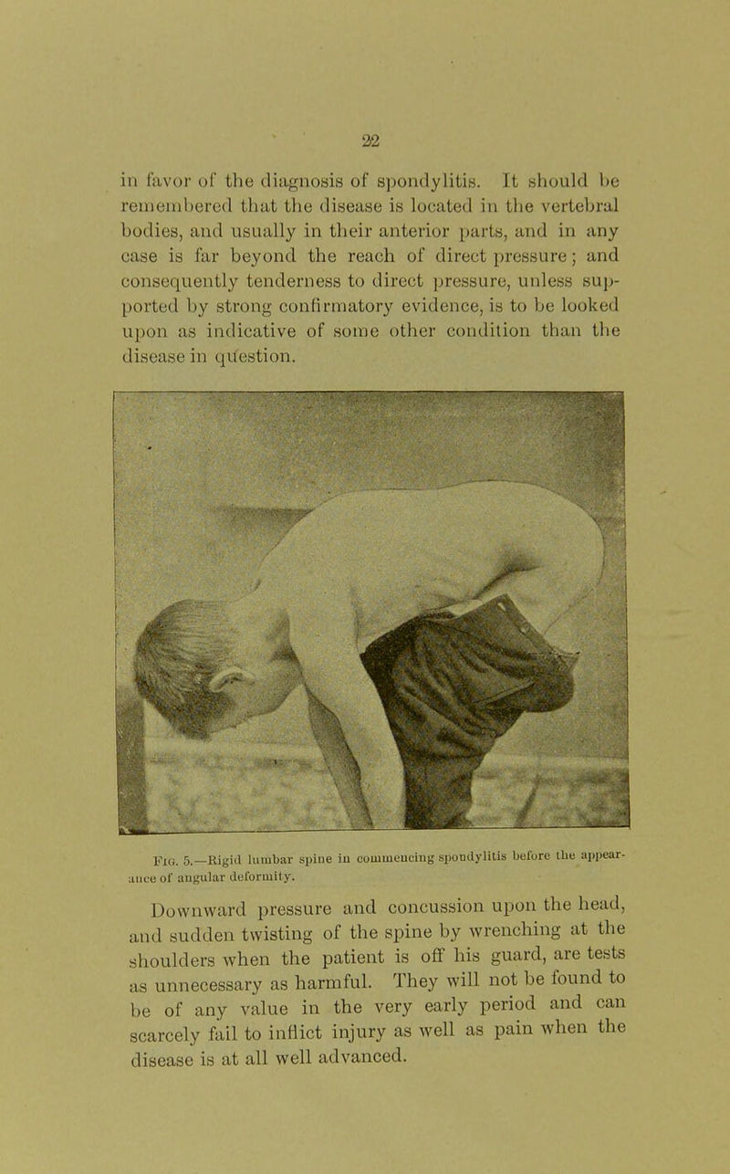 in favor of the diagnosis of spondylitis. It should be remembered that the disease is located in the vertebral bodies, and usually in their anterior parts, and in any case is far beyond the reach of direct pressure; and consequently tenderness to direct pressure, unless sup- ported by strong confirmatory evidence, is to be looked upon as indicative of some other condition than the disease in qifestion. Fia. 5.—Rigid lumbar spiue iu couimeuciug spondylitis belbrc the appear- ance of augular deforuiity. Downward pressure and concussion upon the head, and sudden twisting of the spine by wrenching at the shoulders when the patient is off his guard, are tests as unnecessary as harmful. They will not be found to be of any value in the very early period and can scarcely fail to inflict injury as well as pain when the disease is at all well advanced.