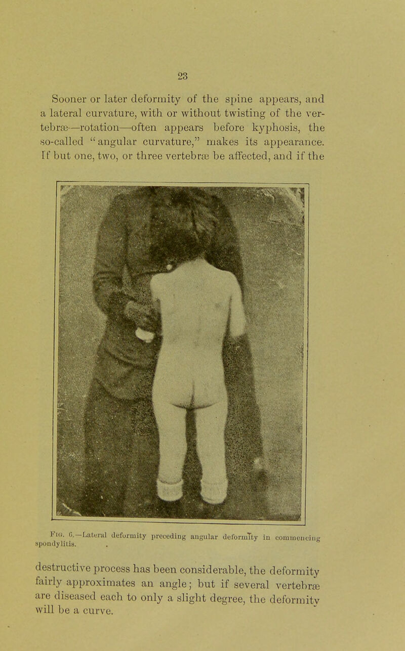 Sooner or later deformity of the spine appears, and a lateral curvature, with or without twisting of the ver- tebras—rotation—often appears before kyphosis, the so-called angular curvature, makes its appearance. If but one, two, or three vertebrae be affected, and if the Fi«. C—Lateral deformity preceding angular deformTty in comineuciiig spondylitis. destructive process has been considerable, the deformity fairly approximates an angle; but if several vertebrse are diseased each to only a slight degree, the deformity will be a curve.