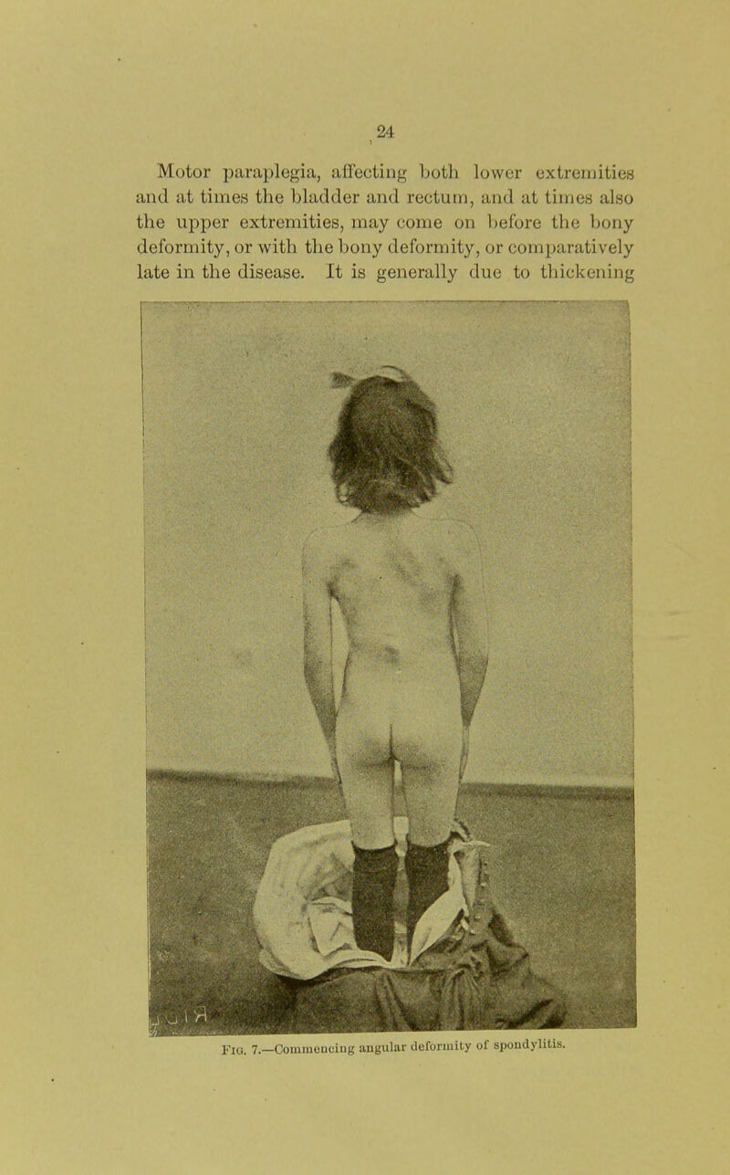 Motor paraplegia, affecting both lower extremities and at times the bladder and rectum, and at times also the upper extremities, may come on Ijefore the bony deformity, or with the bony deformity, or comparatively late in the disease. It is generally due to thickening Fig. 7.—Commeuciug angular deformity of spondylitis.