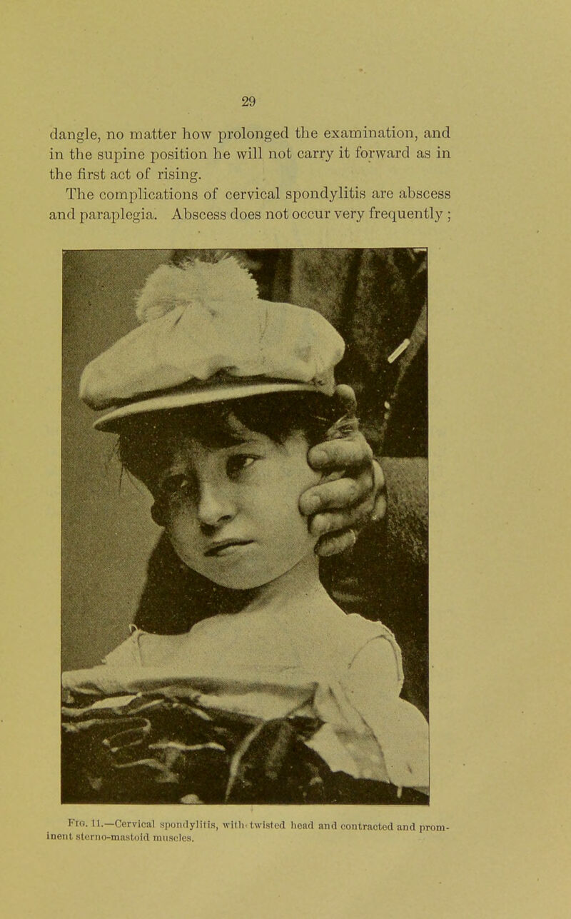 dangle, no matter how prolonged the examination, and in the supine position he will not carry it forward as in the first act of rising. The complications of cervical spondylitis are abscess and paraplegia. Abscess does not occur very frequently ; Fto. n.—Cervical spondylitis, with.twisted head and contracted and prom- inent sterno-mastoid muscles.