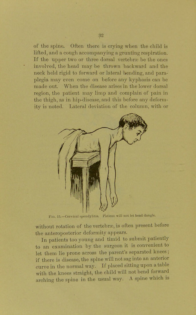 of the spine. Often there is crying when the child is lifted, and a cough accompanying a grunting respiration. If the upper two or three dorsal vertehra; he the ones involved, the head may he thrown backward and the neck held rigid to forward or lateral liending, and para- plegia may even come on before any kyphosis can be made out. When the disease arises in the lower dorsal region, the patient may limp and complain of pain in the thigh, as in hip-disease, and this before any deform- ity is noted. Lateral deviation of the column, with or Fjg. IH.—Cervical .spondylitis. Palicut will uot let head dangle. without rotation of the vertebrse, is often present before the anteroposterior deformity appears. In patients too young and timid to submit patiently to an examination by the surgeon it is convenient to let them lie prone across the parent's separated knees; if there is disease, the spine will not sag into an anterior curve in the normal way. If placed sitting upon a table with the knees straight, the child will not bend forward arching the spine in the usual way. A spine which is