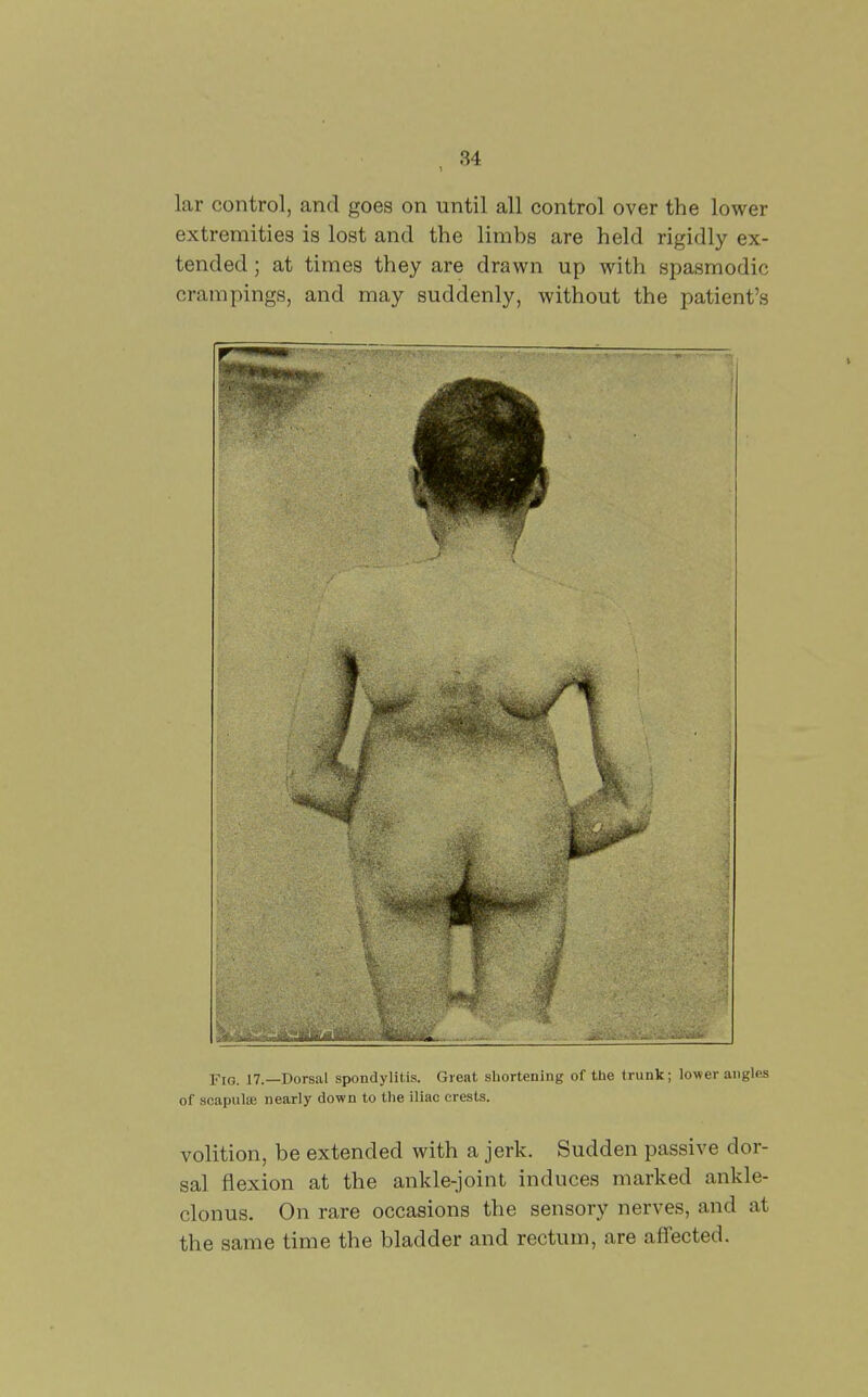lar control, and goes on until all control over the lower extremities is lost and the limhs are held rigidly ex- tended ; at times they are drawn up with spasmodic crampings, and may suddenly, without the patient's Fig. 17.—Dorsal spondylitis. Great shortening of the trunk; lower angles of scapulae nearly down to the iliac crests. volition, be extended with a jerk. Sudden passive dor- sal flexion at the ankle-joint induces marked ankle- clonus. On rare occasions the sensory nerves, and at the same time the bladder and rectum, are affected.