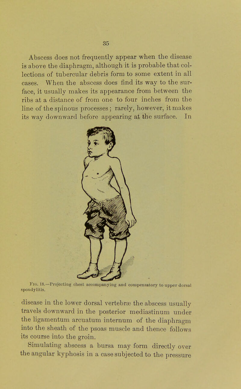 Abscess does not frequently appear when the disease is above the diaphragm, although it is probable that col- lections of tubercular debris form to some extent in all cases. When the abscess does find its way to the sur- face, it usually makes its appearance from between the ribs at a distance of from one to four inches from the line of the spinous processes; rarely, however, it makes its way downward before appearing at the surface. In Fia. 18.—Projecting chest accompanying and compensatory to upper dorsal spondylitis. disease in the lower dorsal vertebrae the abscess usually travels downward in the posterior mediastinum under the ligamentum arcuatum internum of the diaphragm into the sheath of the psoas muscle and thence follows its course into the groin. Simulating abscess a bursa may form directly over the angular kyphosis in a case subjected to the pressure