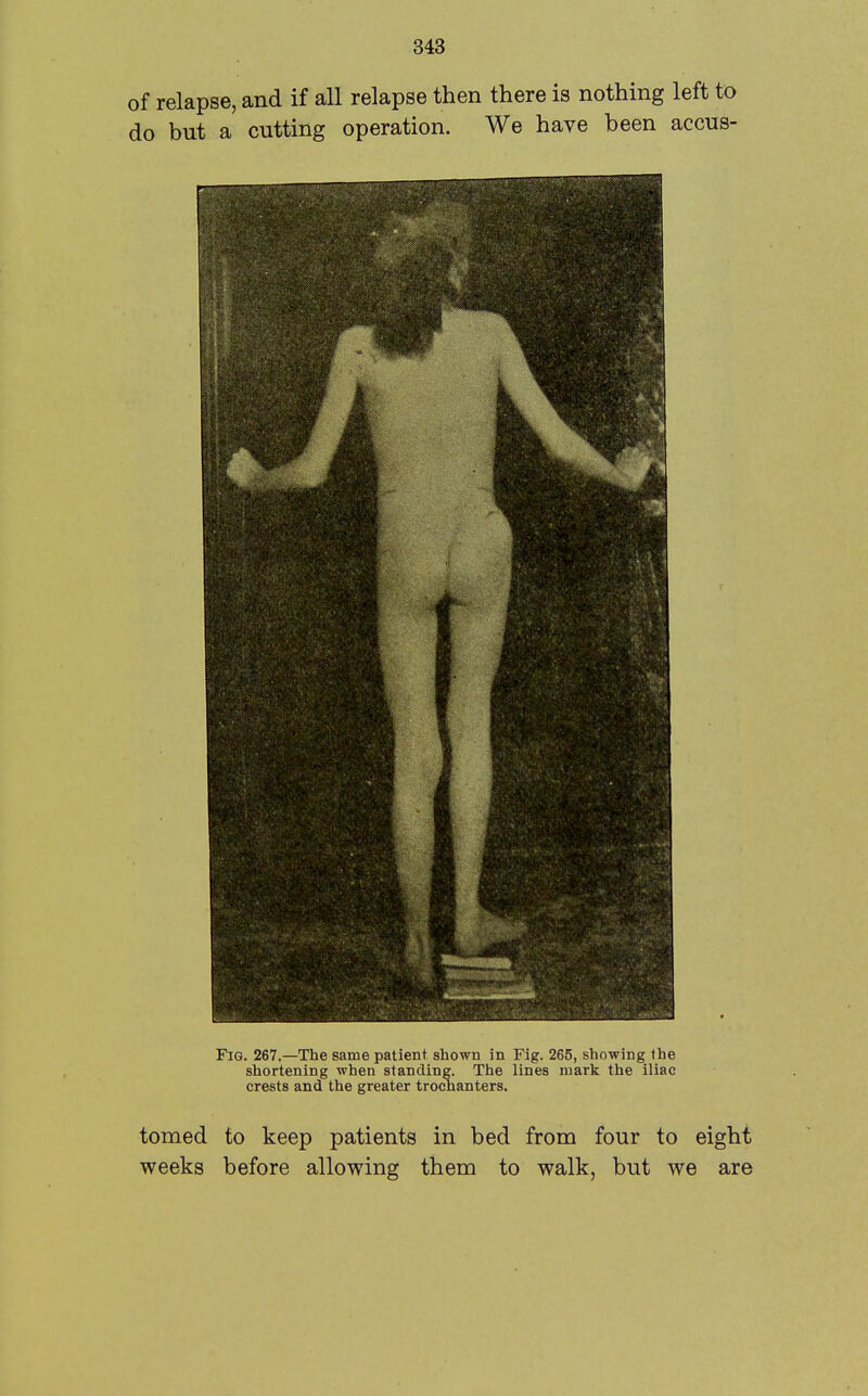 of relapse, and if all relapse then there is nothing left to do but a cutting operation. We have been accus- FiG. 267.—The same patient showu in Fig. 265, showing the shortening when standing. The lines mark the iliac crests and the greater trochanters. tomed to keep patients in bed from four to eight weeks before allowing them to walk, but we are