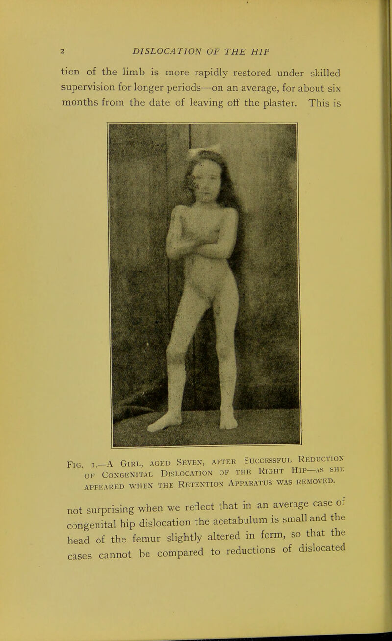 tion of the limb is more rapidly restored under skilled supervision for longer periods—on an average, for about six months from the date of leaving off the plaster. This is Fig i-A Girl, aged Seven, after Successful Reduction of Congenital Dislocation of the Right Hip-as she APPEARED WHEN THE RETENTION APPARATUS WAS REMOVED. not surprising when we reflect that in an average case of congenital hip dislocation the acetabulum is small and the head of the femur slightly altered in form, so that the cases cannot be compared to reductions of dislocated