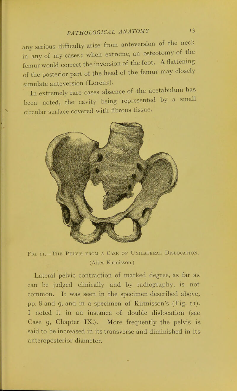 any serious difficulty arise from anteversion of the neck in any of my cases; when extreme, an osteotomy of the femur would correct the inversion of the foot. A flattening of the posterior part of the head of the femur may closely simulate anteversion (Lorenz). In extremely rare cases absence of the acetabulum has been noted, the cavity being represented by a small circular surface covered with fibrous tissue. Fig. ii—The Pelvis from a Case of Unilateral Dislocation. (After Kirmisson.) Lateral pelvic contraction of marked degree, as far as can be judged clinically and by radiography, is not common. It was seen in the specimen described above, pp. 8 and 9, and in a specimen of Kirmisson's (Fig. 11). I noted it in an instance of double dislocation (see Case g, Chapter IX.). More frequently the pelvis is said to be increased in its transverse and diminished in its anteroposterior diameter.