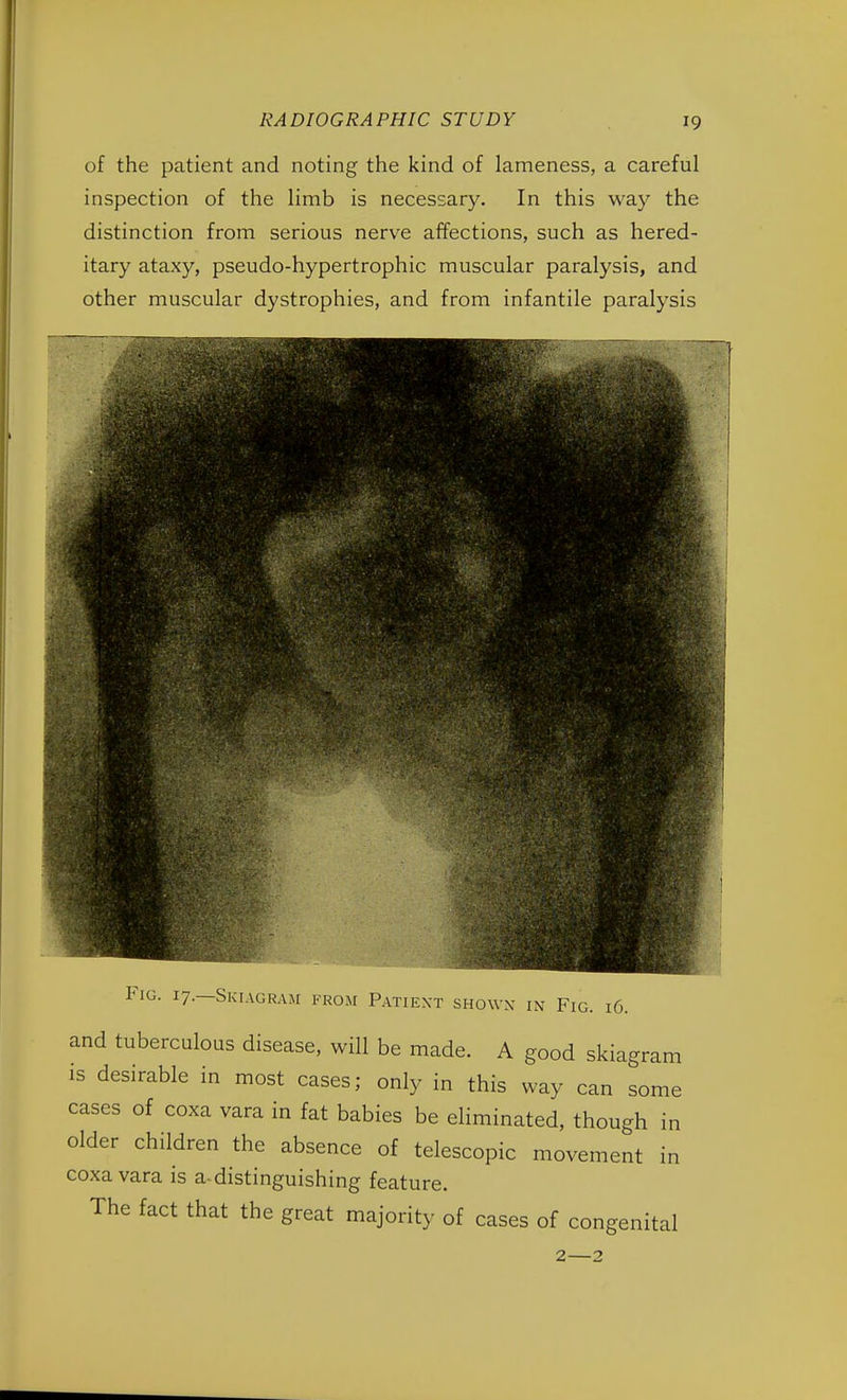 of the patient and noting the kind of lameness, a careful inspection of the limb is necessary. In this way the distinction from serious nerve affections, such as hered- itary ataxy, pseudo-hypertrophic muscular paralysis, and other muscular dystrophies, and from infantile paralysis Fig. 17.—Skiagram from Patient shown in Fig. 16. and tuberculous disease, will be made. A good skiagram is desirable in most cases; only in this way can some cases of coxa vara in fat babies be eliminated, though in older children the absence of telescopic movement in coxa vara is a-distinguishing feature. The fact that the great majority of cases of congenital