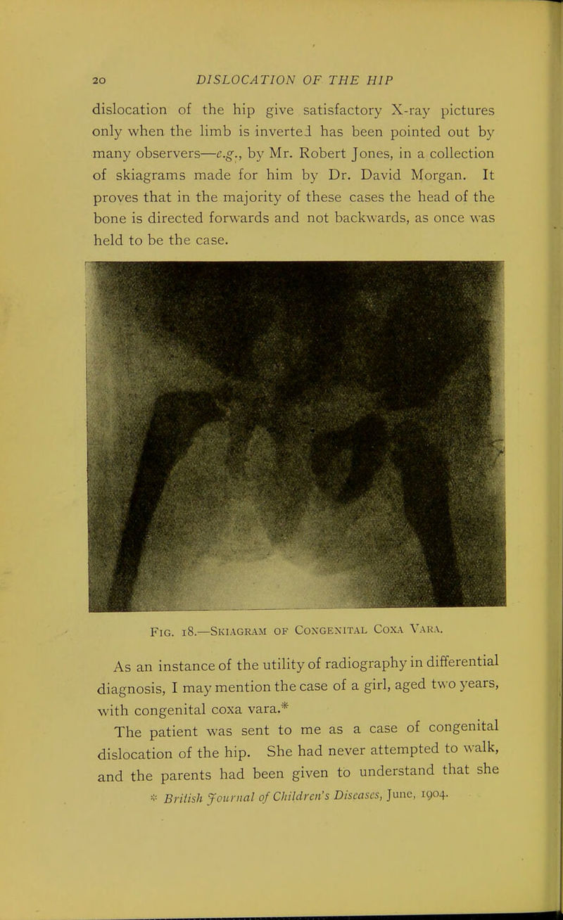 dislocation of the hip give satisfactory X-ray pictures only when the limb is inverted has been pointed out by many observers—e.g., by Mr. Robert Jones, in a collection of skiagrams made for him by Dr. David Morgan. It proves that in the majority of these cases the head of the bone is directed forwards and not backwards, as once was held to be the case. Fig. 18.—Skiagram of Congenital Coxa Vara. As an instance of the utility of radiography in differential diagnosis, I may mention the case of a girl, aged two years, with congenital coxa vara.* The patient was sent to me as a case of congenital dislocation of the hip. She had never attempted to walk, and the parents had been given to understand that she * British Journal of Children's Diseases, June, 1904.