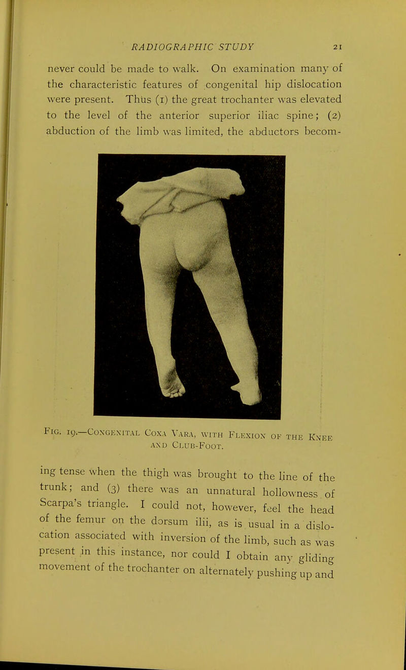 never could be made to walk. On examination man)' of the characteristic features of congenital hip dislocation were present. Thus (i) the great trochanter was elevated to the level of the anterior superior iliac spine; (2) abduction of the limb was limited, the abductors becom- Fig. 19.—Congenital Coxa Vara, with Flexion ok the Knee and Club-Foot. ing tense when the thigh was brought to the line of the trunk; and (3) there was an unnatural hollowness of Scarpa's triangle. I could not, however, feel the head of the femur on the dorsum ilii, as is usual in a dislo- cation associated with inversion of the limb, such as was present in this instance, nor could I obtain any gliding movement of the trochanter on alternately pushing up and