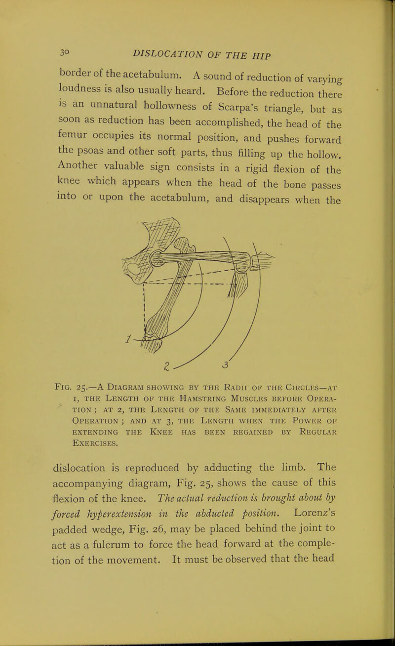 border of the acetabulum. A sound of reduction of varying loudness is also usually heard. Before the reduction there is an unnatural hollowness of Scarpa's triangle, but as soon as reduction has been accomplished, the head of the femur occupies its normal position, and pushes forward the psoas and other soft parts, thus filling up the hollow. Another valuable sign consists in a rigid flexion of the knee which appears when the head of the bone passes into or upon the acetabulum, and disappears when the Fig. 25.—A Diagram showing by the Radii of the Circles—at i, the Length of the Hamstring Muscles before OperxV- tion j at 2, the length of the same immediately after Operation ; and at 3, the Length when the Power of extending the knee has been regained by regular Exercises. dislocation is reproduced by adducting the limb. The accompanying diagram, Fig. 25, shows the cause of this flexion of the knee. The actual reduction is brought about by forced hyperextension in the abducted position. Lorenz's padded wedge, Fig. 26, may be placed behind the joint to act as a fulcrum to force the head forward at the comple- tion of the movement. It must be observed that the head