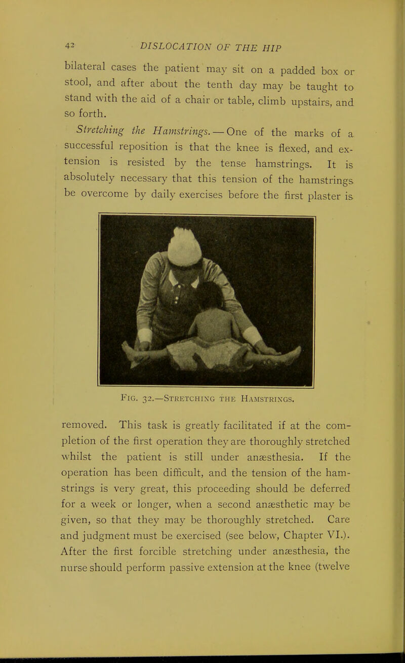 bilateral cases the patient may sit on a padded box or stool, and after about the tenth day may be taught to stand with the aid of a chair or table, climb upstairs, and so forth. Stretching the Hamstrings. — One of the marks of a successful reposition is that the knee is flexed, and ex- tension is resisted by the tense hamstrings. It is absolutely necessary that this tension of the hamstrings be overcome by daily exercises before the first plaster is Fig. 32.—Stretchixg the Hamstrings. removed. This task is greatly facilitated if at the com- pletion of the first operation they are thoroughly stretched whilst the patient is still under anaesthesia. If the operation has been difficult, and the tension of the ham- strings is very great, this proceeding should be deferred for a week or longer, when a second anaesthetic may be given, so that they may be thoroughly stretched. Care and judgment must be exercised (see below, Chapter VI.). After the first forcible stretching under anaesthesia, the nurse should perform passive extension at the knee (twelve