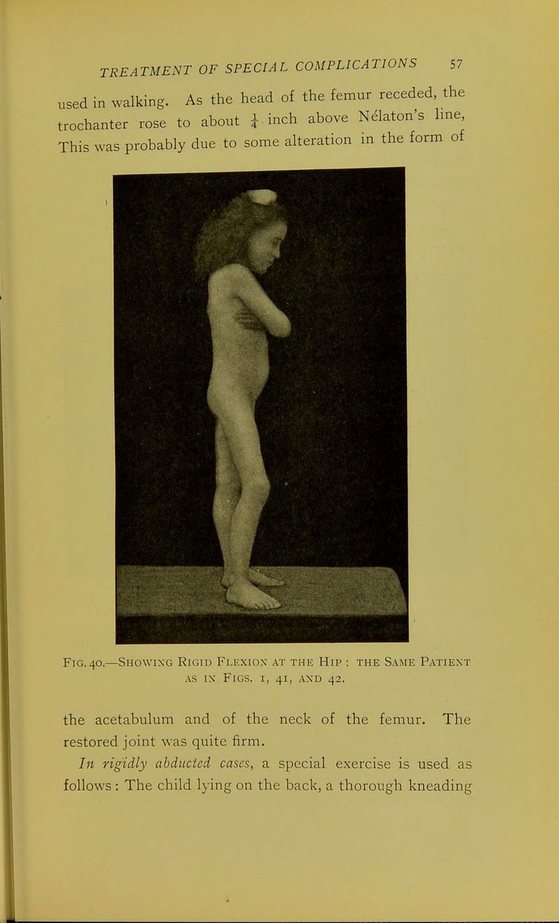 used in walking. As the head of the femur receded, the trochanter rose to about * inch above Nekton's line, This was probably due to some alteration in the form of Fig.40.—Showing Rigid Flexion at the Hip : the Same Patient as in Figs, i, 41, and 42. the acetabulum and of the neck of the femur. The restored joint was quite firm. In rigidly abducted cases, a special exercise is used as follows: The child lying on the back, a thorough kneading