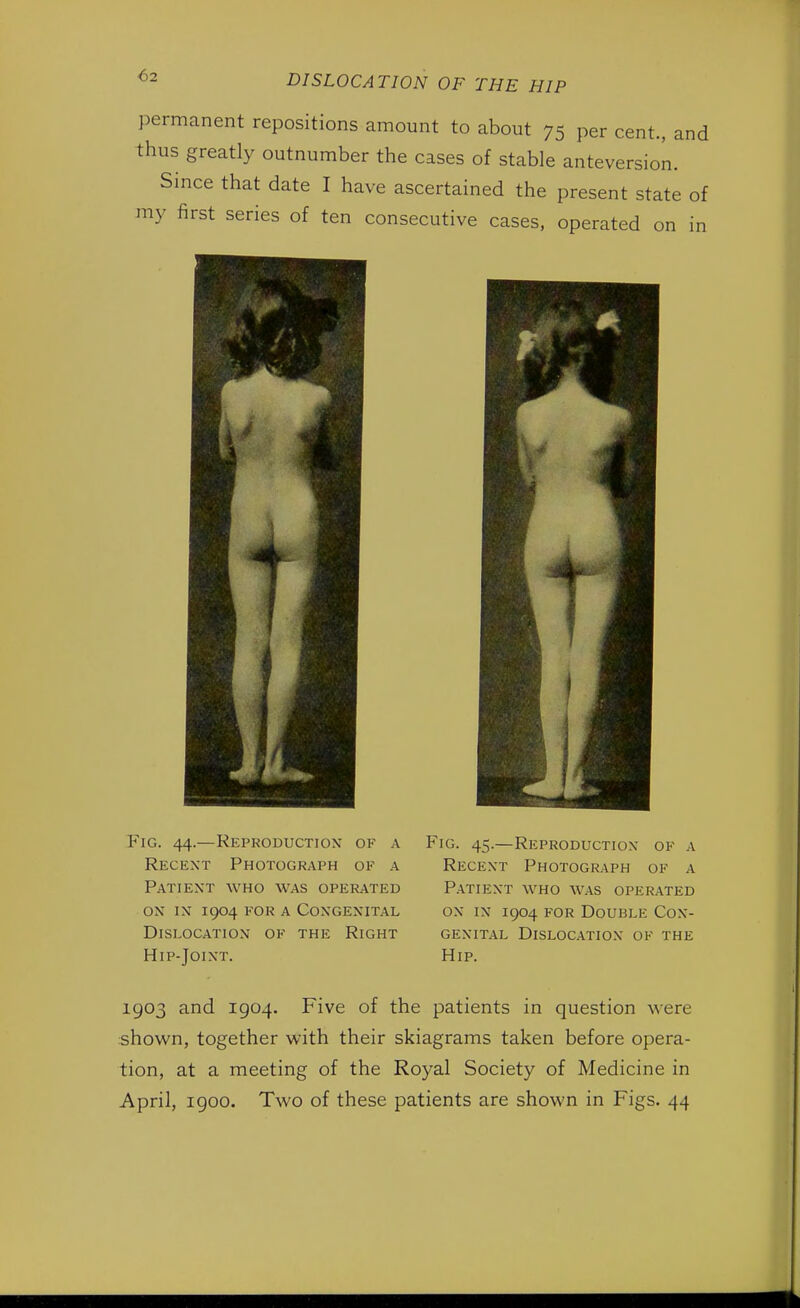 permanent repositions amount to about 75 per cent., and thus greatly outnumber the cases of stable anteversion. Since that date I have ascertained the present state of my first series of ten consecutive cases, operated on in Fig. 44.—Reproduction- of a Recent Photograph of a Patient who was operated on in 1904 for a Congenital Dislocation of the Right Hip-Joint. Fig. 45.—Reproduction of a Recent Photograph of a Patient who was operated on in 1904 for Double Con- genital Dislocation of the Hip. 1903 and 1904. Five of the patients in question were shown, together with their skiagrams taken before opera- tion, at a meeting of the Royal Society of Medicine in April, igoo. Two of these patients are shown in Figs. 44