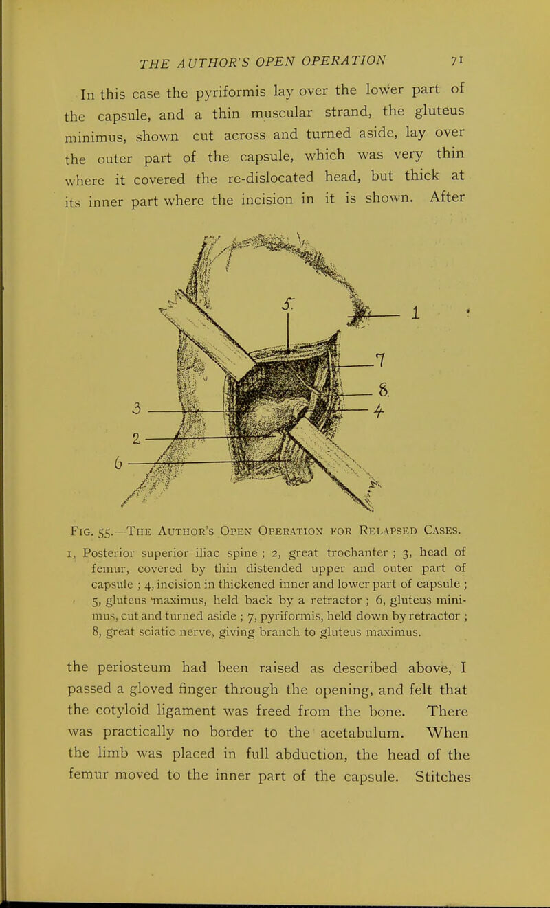 In this case the pyriformis lay over the lower part of the capsule, and a thin muscular strand, the gluteus minimus, shown cut across and turned aside, lay over the outer part of the capsule, which was very thin where it covered the re-dislocated head, but thick at its inner part where the incision in it is shown. After 1 Fig. 55.—The Author's Opex Operation for Relapsed Cases. 1, Posterior superior iliac spine; 2, great trochanter; 3, head of femur, covered by thin distended upper and outer part of capsule ; 4, incision in thickened inner and lower part of capsule ; 5, gluteus 'maximus, held back by a retractor ; 6, gluteus mini- mus, cut and turned aside ; 7, pyriformis, held down by retractor ; 8, great sciatic nerve, giving branch to gluteus maximus. the periosteum had been raised as described above, I passed a gloved finger through the opening, and felt that the cotyloid ligament was freed from the bone. There was practically no border to the acetabulum. When the limb was placed in full abduction, the head of the femur moved to the inner part of the capsule. Stitches