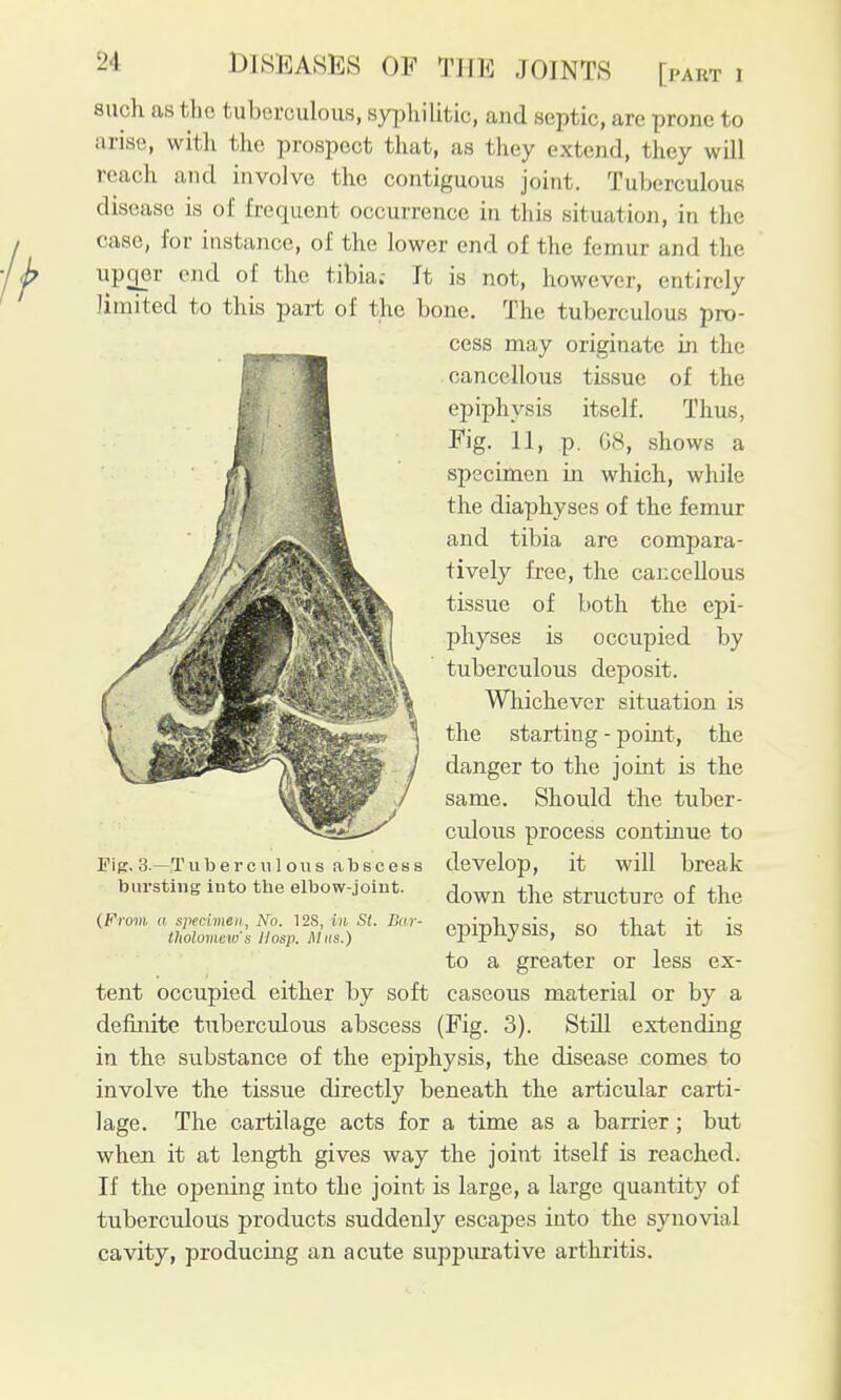 [part 1 such as the tuberculous, syphilitic, and septic, are prone to arise, with the prospect that, as they extend, they will reach and involve the contiguous joint. Tuberculous disease is of frequent occurrence in this situation, in the case, for instance, of the lower end of the femur and the upcjor end of the tibia.- It is not, however, entirely limited to this part of the bone. The tuberculous pro- cess may originate in the cancellous tissue of the epiphysis itself. Thus, Fig. 11, p. G8, shows a specimen in which, while the diaphyses of the femur and tibia are compara- tively free, the cancellous tissue of both the epi- physes is occupied by tuberculous deposit. Whichever situation is the starting - pokit, the danger to the joint is the same. Should the tuber- culous process continue to develop, it will break down the structure of the epiphysis, so that it is to a greater or less ex- caseous material or by a (Fig. 3). StiU extending Fip. 3.—Tuberculoiis abscess bursting into tbe elbow-joint. (From a specimen, No. 12S, in St. Bar- tholomew's Hasp. Mks.) tent occupied either by soft definite tuberculous abscess in the substance of the epiphysis, the disease comes to involve the tissue directly beneath the articular carti- lage. The cartilage acts for a time as a barrier; but when it at length gives way the joint itself is reached. If the opening into the joint is large, a large quantity of tuberculous products suddenly escapes into the synovial cavity, producing an acute suppurative arthritis.