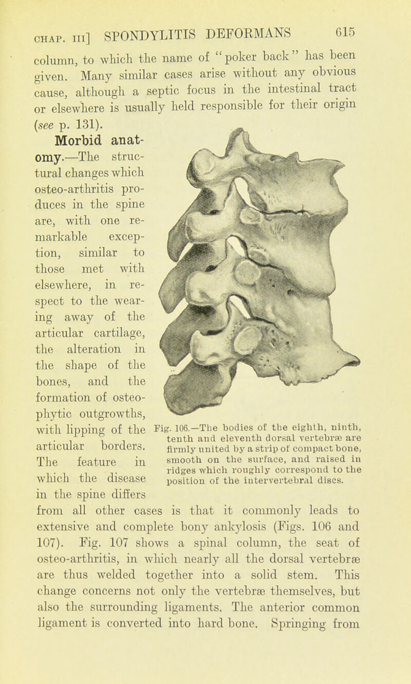 column, to which the name of poker back has been given. Many similar cases arise without any obvious cause, although a septic focus in the intestinal tract or elsewhere is usually held responsible for their origin {see p. 131). Morbid anat- omy.—The struc- tural changes which osteo-arthritis pro- duces in the spine are, with one re- markable excep- tion, similar to those met with elsewhere, in re- spect to the wear- ing away of the articular cartilage, the alteration in the shape of the bones, and the formation of osteo- phytic outgrowths, with lipping of the Fig. 106.—The bodies of tlie eightli, uinth, tentli and eleventh dorsal vertebroe are articular borders. firmly united by a strip of compact bone, The feature in smooth on the surface, and raised iu ridges which roughly correspond to the which the disease position of the intervertebral discs. in the spine differs from all other cases is that it commonly leads to extensive and complete bony ankjdosis (Figs. 106 and 107). Fig. 107 shows a spinal column, the seat of osteo-arthritis, in which nearly all the dorsal vertebrae are thus welded together into a solid stem. This change concerns not only the vertebrae themselves, but also the surrounding ligaments. The anterior common ligament is converted into hard bone. Springing from