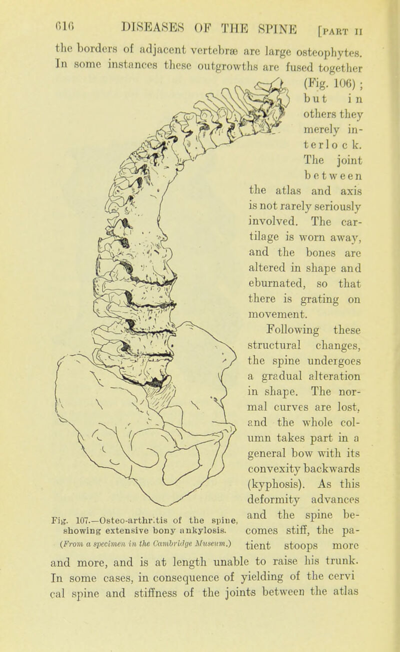 the borders of adjacent vertebrae are large osteophytes. In some instances these outgrowths are fused together (Fig. 106) ; but in others they merely in- ter 1 o c k. The joint between the atlas and axis is not rarely seriously involved. The car- tilage is worn away, and the bones are altered in shape and eburnated, so that there is grating on movement. Following these structural changes, the spine undergoes a gradual alteration in shape. The nor- mal curves are lost, and the whole col- umn takes part in a general bow with its convexity backwards (kyphosis). As this deformity advances Fis. 107.-Osteo-arthr.tis of the spiue, ^^^^ ^P^^^^ showing extensive bony auliylosis. comes stiff, the pa- {Frovi a specimen in the Camhriiige Museum.) ticnt stoops morc and more, and is at length unable to raise his trunk. In some cases, in consequence of yielding of the cervi spine and stiffness of the joints between the atlas ca