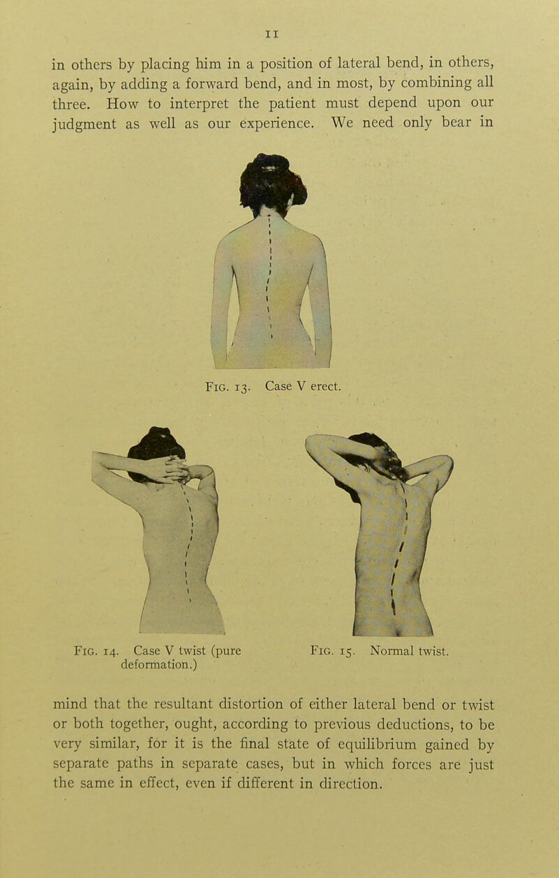 IT in others by placing him in a position of lateral bend, in others, again, by adding a forward bend, and in most, by combining all three. How to interpret the patient must depend upon our judgment as well as our experience. We need only bear in Fig. 13. Case V erect. Fig. 14. Case V twist (pure Fig. 15. Normal twist, deformation.) mind that the resultant distortion of either lateral bend or twist or both together, ought, according to previous deductions, to be very similar, for it is the final state of equilibrium gained by separate paths in separate cases, but in which forces are just the same in effect, even if different in direction.
