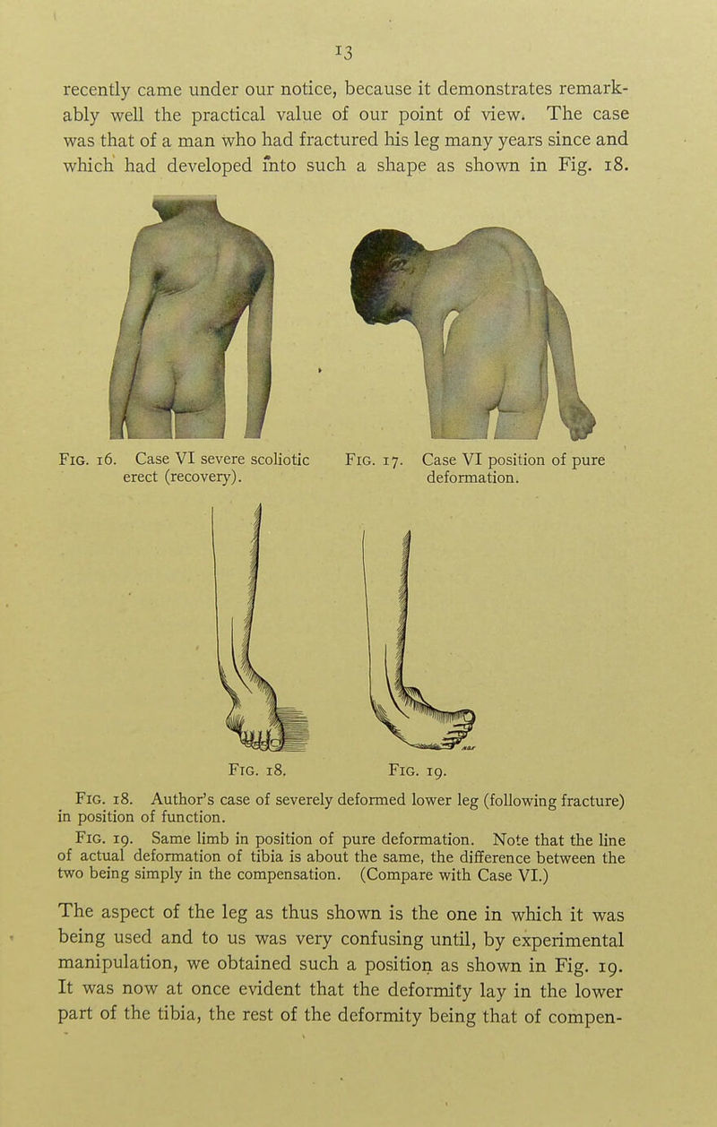 recently came under our notice, because it demonstrates remark- ably well the practical value of our point of view. The case was that of a man who had fractured his leg many years since and which had developed mto such a shape as shown in Fig. 18. Fig. 16. Case VI severe scoliotic Fig. 17. Case VI position of pure erect (recovery). deformation. Fig. 18. Fig. 19. Fig. 18. Author's case of severely deformed lower leg (following fracture) in position of function. Fig. 19. Same limb in position of pure deformation. Note that the line of actual deformation of tibia is about the same, the difference between the two being simply in the compensation. (Compare with Case VI.) The aspect of the leg as thus shown is the one in which it was being used and to us was very confusing until, by experimental manipulation, we obtained such a position as shown in Fig. 19. It was now at once evident that the deformity lay in the lower part of the tibia, the rest of the deformity being that of compen-