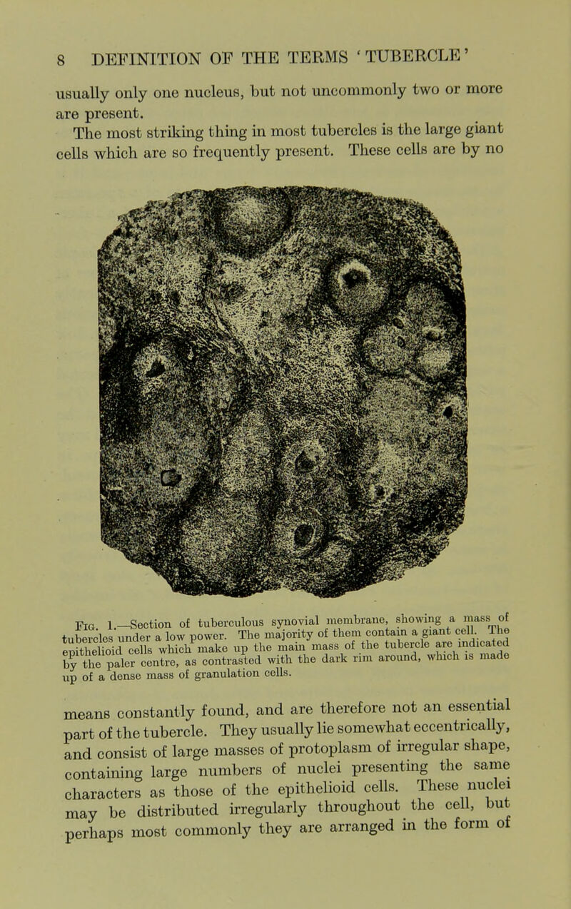 usually only one nucleus, but not uncommonly two or more are present. The most striking thing in most tubercles is the large giant cells which are so frequently present. These cells are by no Fig l._Section of tuberculous synovial membrane, showing a iasb_of tubercles under a low power. The majority of them contain a giant cell. The Sithelioid cells which make up the main mass of the tubercle are indicated by the paler centre, as contrasted with the dark rim around, which is made up of a dense mass of granulation cells. means constantly found, and are therefore not an essential part of the tubercle. They usually lie somewhat eccentrically, and consist of large masses of protoplasm of irregular shape, containing large numbers of nuclei presenting the same characters as those of the epithelioid cells. These nuclei may be distributed hregularly throughout the cell, but perhaps most commonly they are arranged in the form of