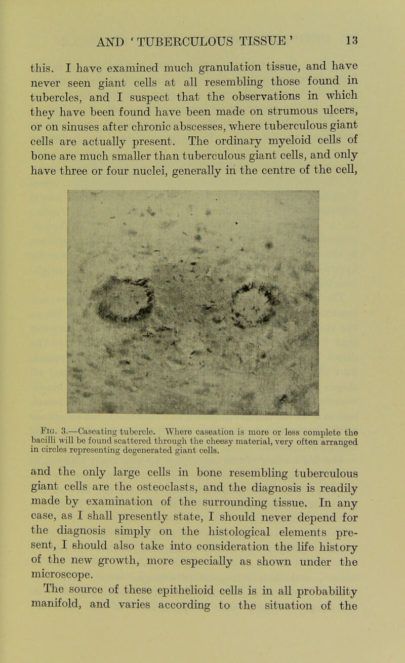 this. I have examined much granulation tissue, and have never seen giant cells at all resembling those found in tubercles, and I suspect that the observations in which they have been found have been made on strumous ulcers, or on sinuses after chronic abscesses, where tuberculous giant cells are actually present. The ordinary myeloid cells of bone are much smaller than tuberculous giant cells, and only have three or four nuclei, generally in the centre of the cell, FiQ. 3.—Casoating tubercle. Where caseation is more or less complete the bacilli will be found scattered through the cheesy material, very often arranged in circles representing degenerated giant cells. and the only large cells in bone resembling tuberculous giant cells are the osteoclasts, and the diagnosis is readily made by examination of the surrounding tissue. In any case, as I shall presently state, I should never depend for the diagnosis simply on the histological elements pre- sent, I should also take into consideration the life history of the new growth, more especially as shown under the microscope. The source of these epithelioid cells is in all probability manifold, and varies according to the situation of the