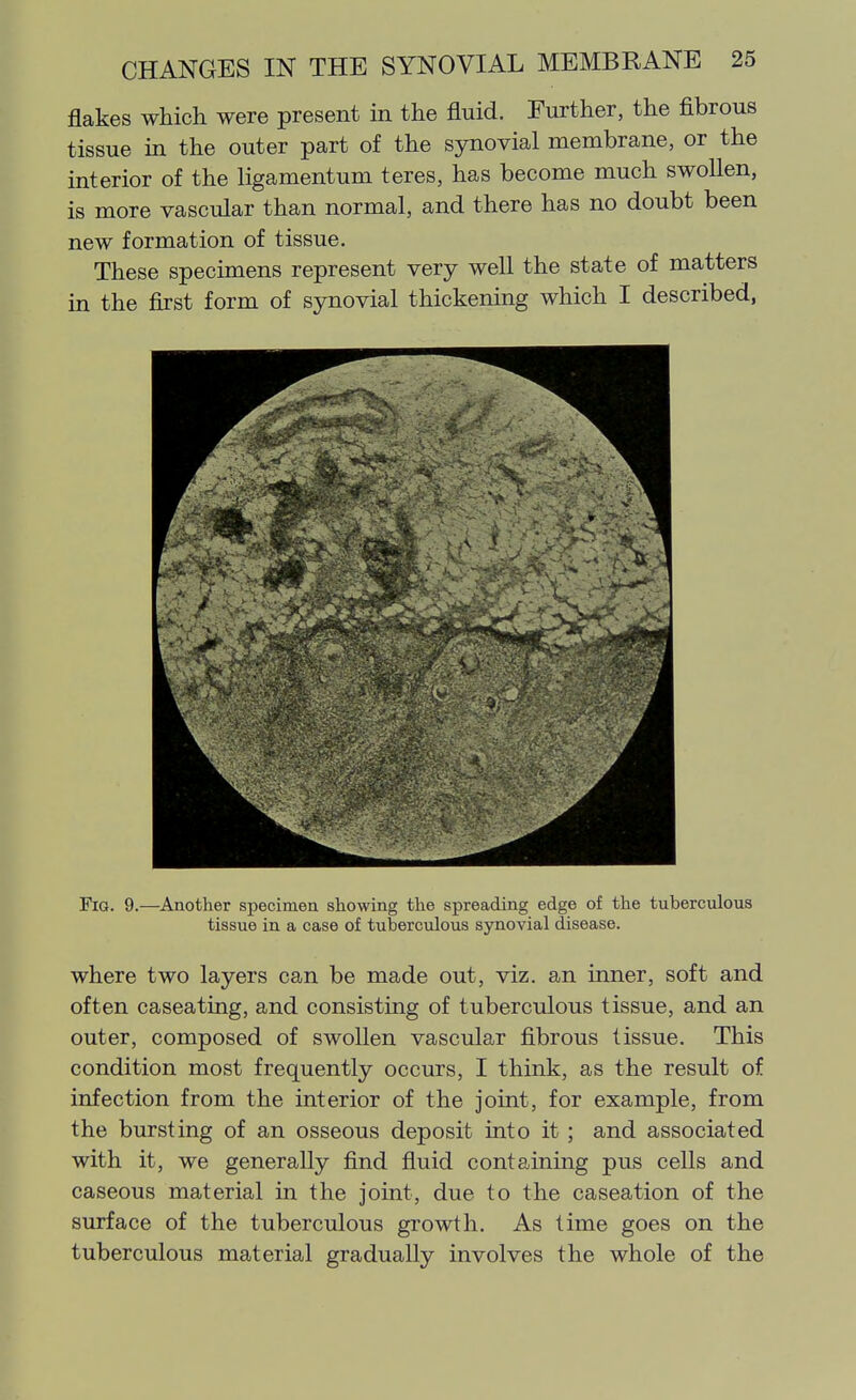 flakes which were present in the fluid. Further, the fibrous tissue in the outer part of the synovial membrane, or the interior of the ligamentum teres, has become much swollen, is more vascular than normal, and there has no doubt been new formation of tissue. These specimens represent very well the state of matters in the first form of synovial thickening which I described, Fig. 9.—Another specimen showing the spreading edge of the tuberculous tissue in a case of tuberculous synovial disease. where two layers can be made out, viz. an inner, soft and often caseating, and consisting of tuberculous tissue, and an outer, composed of swollen vascular fibrous tissue. This condition most frequently occurs, I think, as the result of infection from the interior of the joint, for example, from the bursting of an osseous deposit into it; and associated with it, we generally find fluid containing pus cells and caseous material in the joint, due to the caseation of the surface of the tuberculous growth. As time goes on the tuberculous material gradually involves the whole of the
