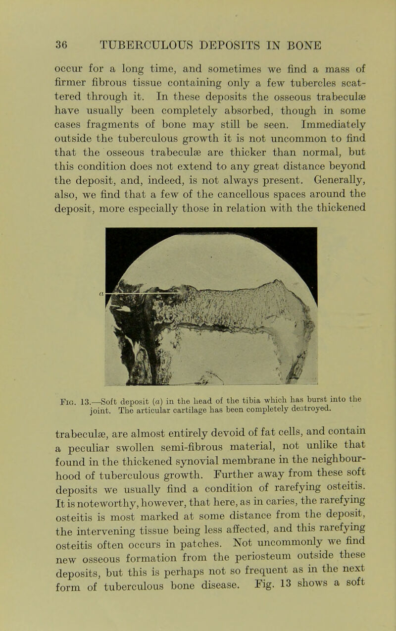 occur for a long time, and sometimes we find a mass of firmer fibrous tissue containing only a few tubercles scat- tered through it. In these deposits the osseous trabeculae have usually been completely absorbed, though in some cases fragments of bone may still be seen. Immediately outside the tuberculous growth it is not uncommon to find that the osseous trabecule are thicker than normal, but this condition does not extend to any great distance beyond the deposit, and, indeed, is not always present. Generally, also, we find that a few of the cancellous spaces around the deposit, more especially those in relation with the thickened Fig. 13.—Soft deposit (a) in the head of the tibia which has burst into the joint. The articular cartilage has been completely destroyed. trabeculse, are almost entirely devoid of fat cells, and contain a peculiar swollen semi-fibrous material, not unlike that found in the thickened synovial membrane in the neighbour- hood of tuberculous growth. Further away from these soft deposits we usually find a condition of rarefying osteitis. It is noteworthy, however, that here, as in caries, the rarefying osteitis is most marked at some distance from the deposit, the intervening tissue being less affected, and this rarefying osteitis often occurs in patches. Not uncommonly we find new osseous formation from the periosteum outside these deposits, but this is perhaps not so frequent as in the next form of tuberculous bone disease. Fig. 13 shows a soft