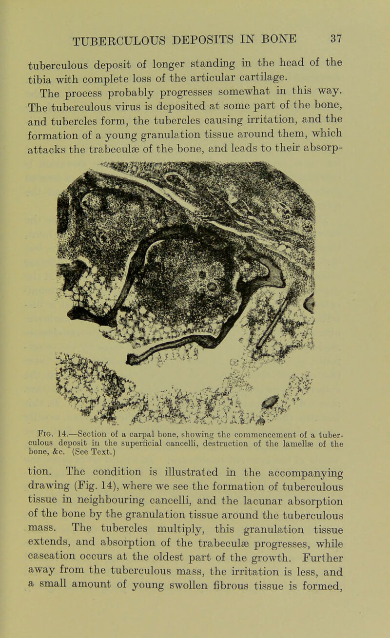tuberculous deposit of longer standing in the head of the tibia with complete loss of the articular cartilage. The process probably progresses somewhat in this way. The tuberculous virus is deposited at some part of the bone, and tubercles form, the tubercles causing irritation, and the formation of a young granulation tissue around them, which attacks the trabeculse of the bone, and leads to then- absorp- FiG. 14.—Section of a carpal bone, showing the commencement of a tuber- culous deposit in the superficial cancelli, destruction of the lamellae of the bone, &c. (See Text.) tion. The condition is illustrated in the accompanying drawing (Fig. 14), where we see the formation of tuberculous tissue in neighbouring cancelli, and the lacunar absorption of the bone by the granulation tissue around the tuberculous mass. The tubercles multiply, this granulation tissue extends, and absorption of the trabeculse progresses, while caseation occurs at the oldest part of the growth. Further away from the tuberculous mass, the irritation is less, and a small amount of young swollen fibrous tissue is formed,