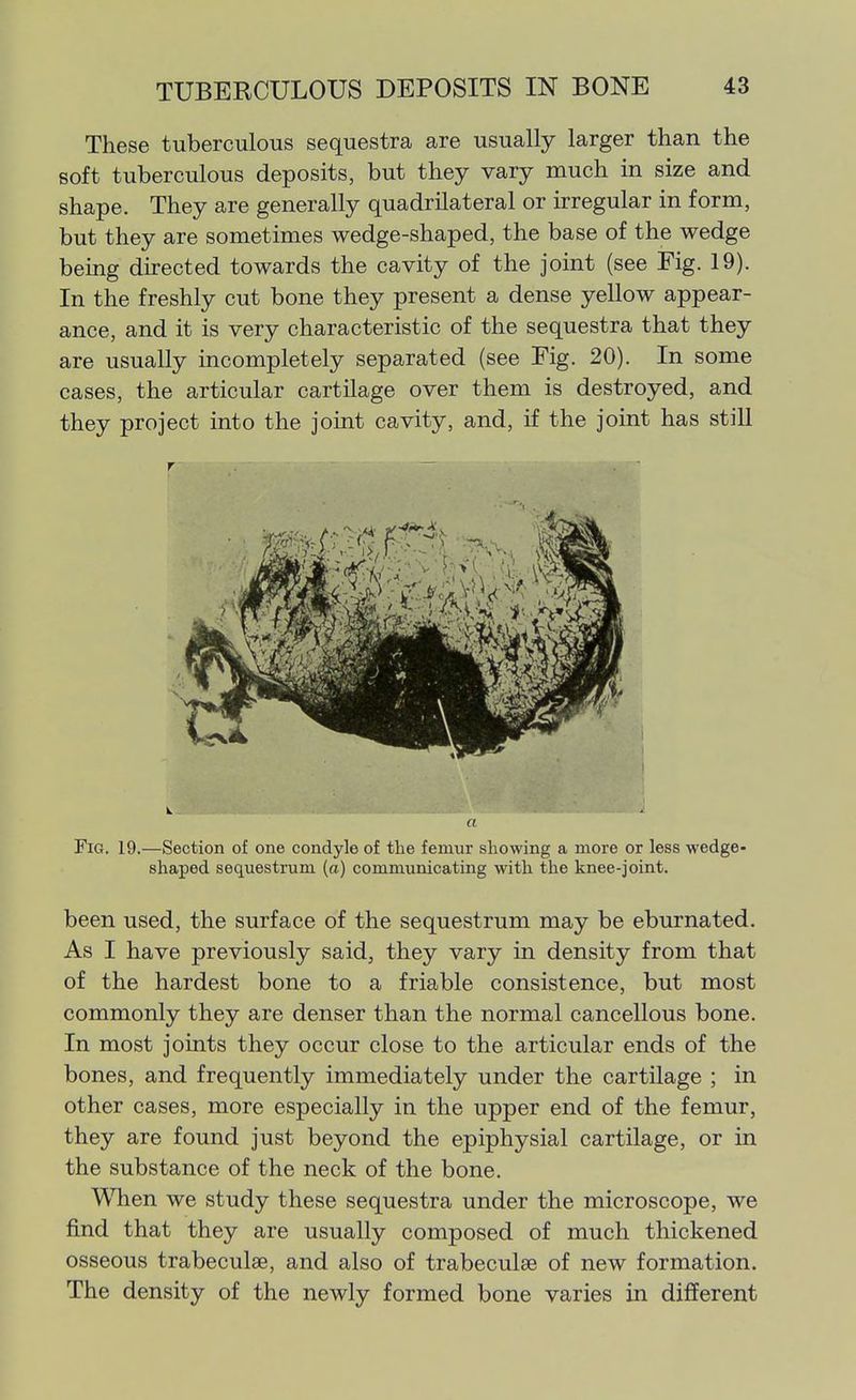 These tuberculous sequestra are usually larger than the soft tuberculous deposits, but they vary much in size and shape. They are generally quadrilateral or irregular in form, but they are sometimes wedge-shaped, the base of the wedge being directed towards the cavity of the joint (see Fig. 19). In the freshly cut bone they present a dense yellow appear- ance, and it is very characteristic of the sequestra that they are usually incompletely separated (see Fig. 20). In some cases, the articular cartilage over them is destroyed, and they project into the joint cavity, and, if the joint has still a Fig. 19.—Section of one condyle of the femur showing a more or less wedge- shaped sequestrum (o) communicating with the knee-joint. been used, the surface of the sequestrum may be eburnated. As I have previously said, they vary in density from that of the hardest bone to a friable consistence, but most commonly they are denser than the normal cancellous bone. In most joints they occur close to the articular ends of the bones, and frequently immediately under the cartilage ; in other cases, more especially in the upper end of the femur, they are found just beyond the epiphysial cartilage, or in the substance of the neck of the bone. When we study these sequestra under the microscope, we find that they are usually composed of much thickened osseous trabeculse, and also of trabeculse of new formation. The density of the newly formed bone varies in different