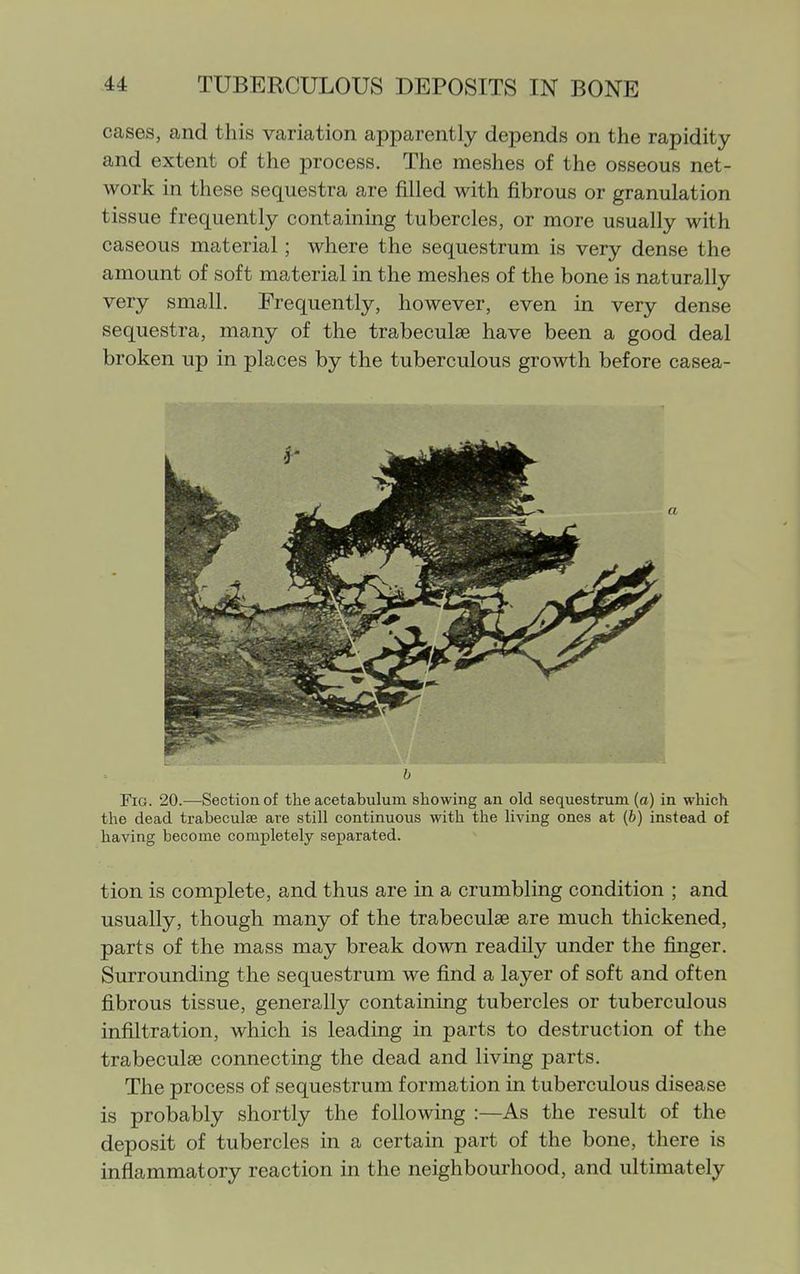 cases, and this variation apparently depends on the rapidity and extent of the process. The meshes of the osseous net- work in these sequestra are filled with fibrous or granulation tissue frequently containing tubercles, or more usually with caseous material; where the sequestrum is very dense the amount of soft material in the meshes of the bone is naturally very small. Frequently, however, even in very dense sequestra, many of the trabeculae have been a good deal broken up in places by the tuberculous growth before casea- b Fig. 20.—Section of the acetabulum showing an old sequestrum (a) in which the dead trabeculse are still continuous with the living ones at {b) instead of having become completely separated. tion is complete, and thus are in a crumbling condition ; and usually, though many of the trabeculse are much thickened, parts of the mass may break down readily under the finger. Surrounding the sequestrum we find a layer of soft and often fibrous tissue, generally containing tubercles or tuberculous infiltration, which is leading in parts to destruction of the trabeculse connecting the dead and living parts. The process of sequestrum formation in tuberculous disease is probably shortly the following :—As the result of the deposit of tubercles in a certain part of the bone, there is inflammatory reaction in the neighbourhood, and ultimately