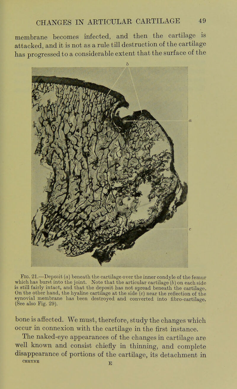 membrane becomes infected, and then the cartilage is attacked, and it is not as a rule till destruction of the cartilage has progressed to a considerable extent that the surface of the b Fig. 21.—Deposit (a) beneath the cartilage over the inner condyle of the femur which has burst into the joint. Note that the articular cartilage (b) on each side is still fairly intact, and that the deposit has not spread beneath the cartilat^e. On the other hand, the hyaline cartilage at the side (c) near the reflection of tlie synovial membrane has been destroyed and converted into fibro-cartilage. (See also Fig. 29). bone is affected. We must, therefore, study the changes which occur in connexion with the cartilage in the first instance. The naked-eye appearances of the changes in cartilage are well known and consist chiefly in thinning, and complete disappearance of portions of the cartilage, its detachment in CHEYNB U,