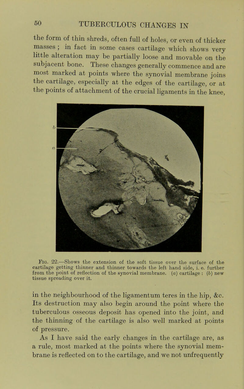 TUBERCULOUS CHANGES IN the form of thin shreds, often full of holes, or even of thicker masses ; in fact in some cases cartilage which shows very little alteration may be partially loose and movable on the subjacent bone. These changes generally commence and are most marked at points where the synovial membrane joins the cartilage, especially at the edges of the cartilage, or at the points of attachment of the crucial ligaments in the knee, Fia. 22.—Shows the extension of the soft tissue over the surface of the cartilage getting thinner and thinner towards the left hand side, i. e. further from the point of reflection of the synovial membrane, {a) cartilage : (6) new tissue spreading over it. in the neighbourhood of the ligamentum teres in the hip, &c. Its destruction may also begin around the point where the tuberculous osseous deposit has opened into the joint, and the thinning of the cartilage is also well marked at points of pressure. As I have said the early changes in the cartilage are, as a rule, most marked at the points where the synovial mem- brane is reflected on to the cartilage, and we not unfrequently