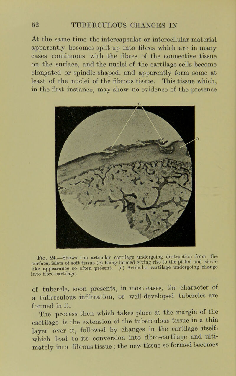 At the same time the intercapsular or intercellular material apparently becomes split up into fibres which are in many- cases continuous with the fibres of the connective tissue on the surface, and the nuclei of the cartilage cells become elongated or spindle-shaped, and apparently form some at least of the nuclei of the fibrous tissue. This tissue which, in the first instance, may show no evidence of the presence a Fig. 24.—Shows the articular cartilage undergoing destruction from the surface, islets of soft tissue (a) being formed giving rise to the pitted and sieve- like appearance so often present, (fe) Articular cartilage undergoing change into fibro-cartilage. of tubercle, soon presents, m most cases, the character of a tuberculous infiltration, or well-developed tubercles are formed in it. The process then which takes place at the margin of the cartilage is the extension of the tuberculous tissue in a thin layer over it, followed by changes in the cartilage itself, which lead to its conversion into fibro-cartilage and ulti- mately into fibrous tissue; the neAV tissue so formed becomes