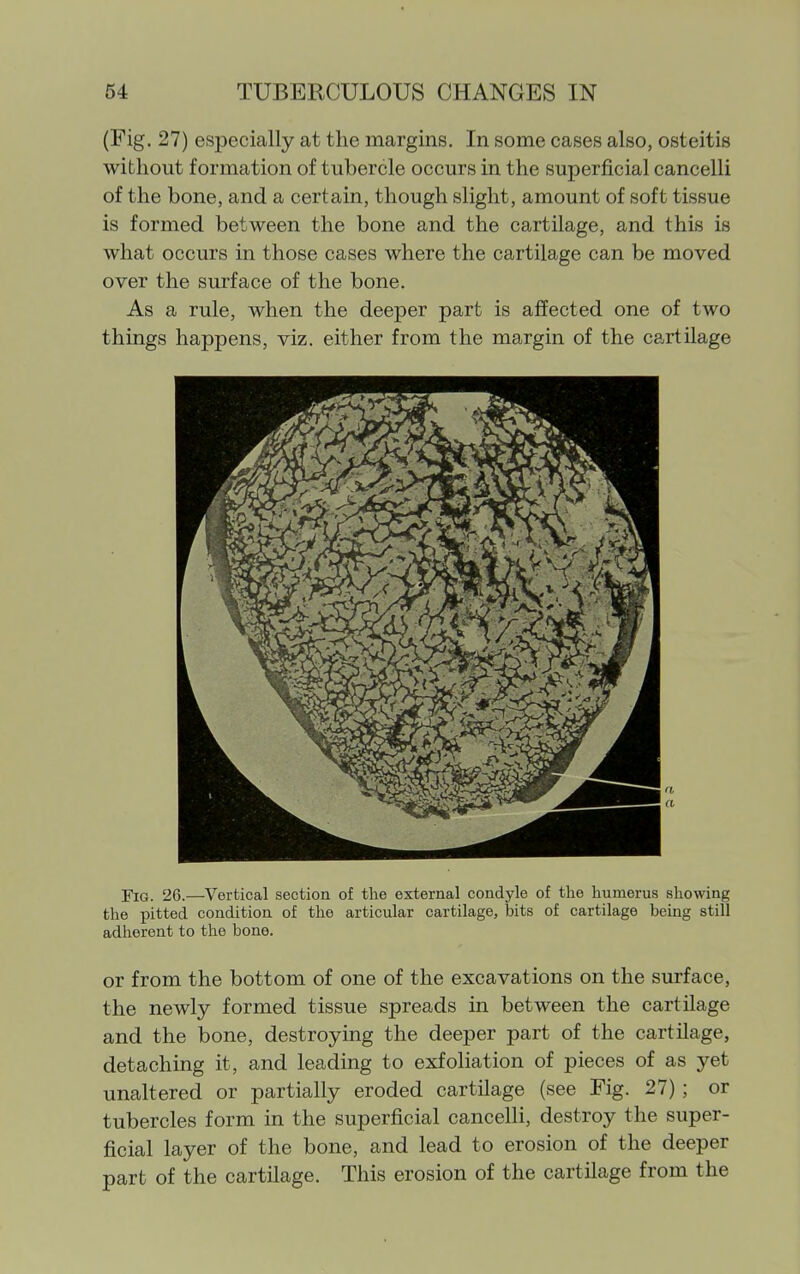 (Fig. 27) especially at the margins. In some cases also, osteitis without formation of tubercle occurs in the superficial cancelli of the bone, and a certain, though slight, amount of soft tissue is formed between the bone and the cartilage, and this is what occurs in those cases where the cartilage can be moved over the surface of the bone. As a rule, when the deeper part is affected one of two things happens, viz. either from the margin of the cartilage Fig. 26.—Vertical section of the external condyle of the humerus showing the pitted condition of the articular cartilage, bits of cartilage being still adherent to the bone. or from the bottom of one of the excavations on the surface, the newly formed tissue spreads in between the cartilage and the bone, destroymg the deeper part of the cartilage, detaching it, and leading to exfoliation of pieces of as yet unaltered or partially eroded cartilage (see Fig. 27) ; or tubercles form in the superficial cancelli, destroy the super- ficial layer of the bone, and lead to erosion of the deeper part of the cartilage. This erosion of the cartilage from the