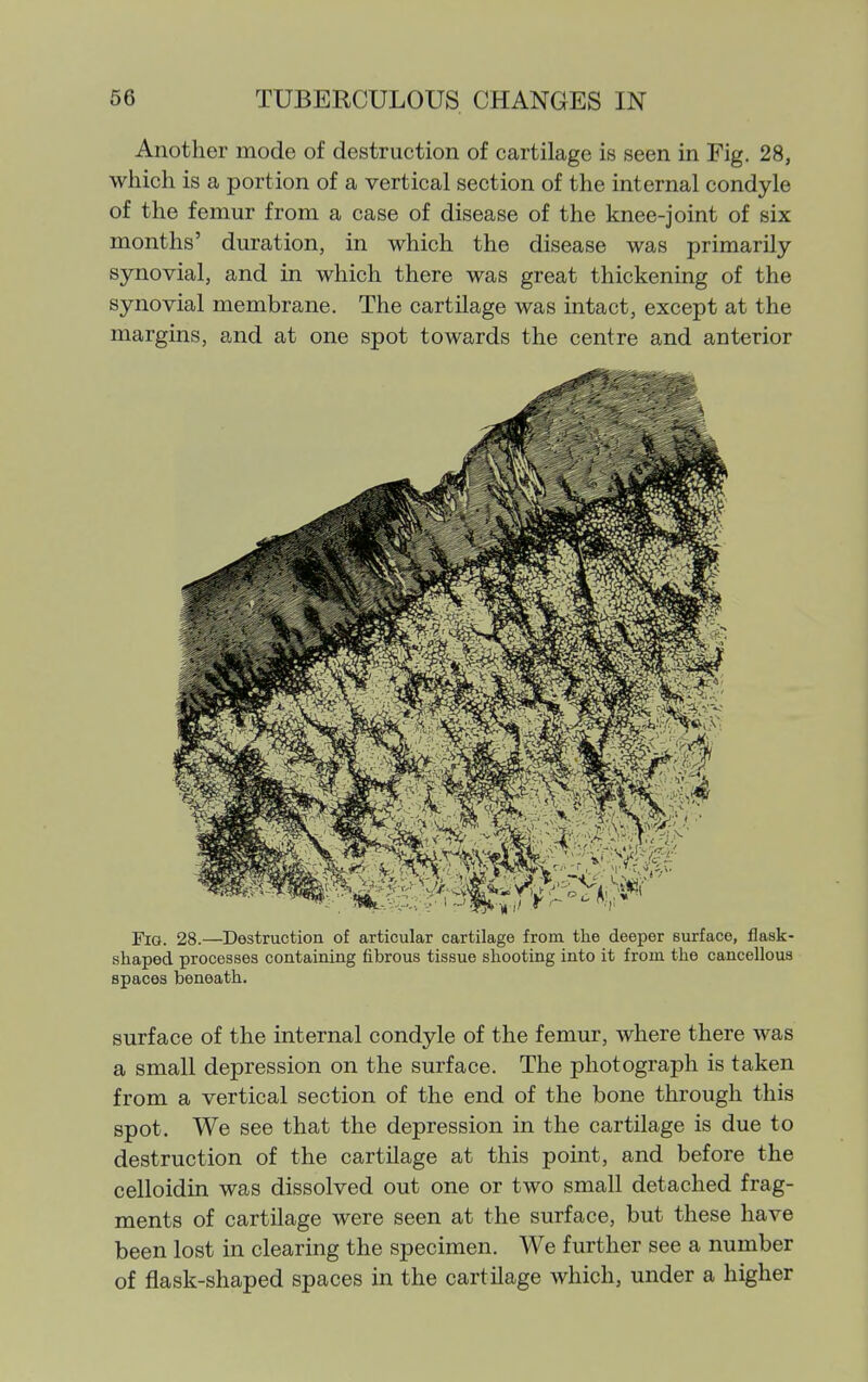 Another mode of destruction of cartilage is seen in Fig. 28, which is a portion of a vertical section of the internal condyle of the femur from a case of disease of the knee-joint of six months' duration, in which the disease was primarily synovial, and in which there was great thickening of the synovial membrane. The cartilage was intact, except at the margins, and at one spot towards the centre and anterior Fig. 28.—Destruction of articular cartilage from the deeper surface, flask- shaped processes containing fibrous tissue shooting into it from the cancellous spaces beneath. surface of the internal condyle of the femur, where there was a small depression on the surface. The photograph is taken from a vertical section of the end of the bone through this spot. We see that the depression in the cartilage is due to destruction of the cartilage at this point, and before the celloidin was dissolved out one or two small detached frag- ments of cartilage were seen at the surface, but these have been lost in clearing the specimen. We further see a number of flask-shaped spaces in the cartilage which, under a higher
