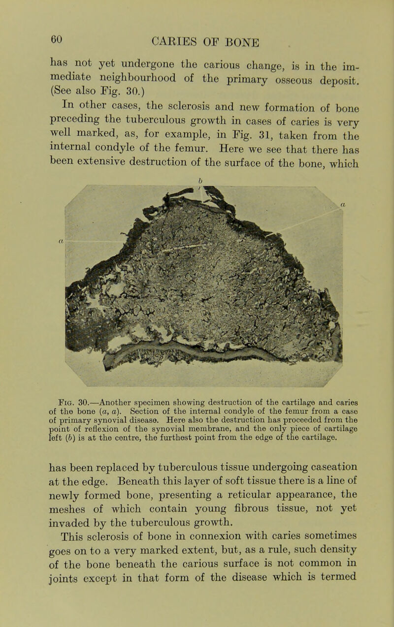 has not yet undergone the carious change, is in the im- mediate neighbourhood of the primary osseous deposit. (See also Fig. 30.) In other cases, the sclerosis and new formation of bone preceding the tuberculous growth in cases of caries is very well marked, as, for example, in Fig. 31, taken from the internal condyle of the femur. Here we see that there has been extensive destruction of the surface of the bone, which b Fig. 30.—Another specimen showing destruction of the cartilage and caries of the bone (a, a). Section of the internal condyle of the femur from a case of primary synovial disease. Here also the destruction has proceeded from the point of reflexion of the synovial membrane, and the only piece of cartilage left (6) is at the centre, the furthest point from the edge of the cartilage. has been replaced by tuberculous tissue undergoing caseation at the edge. Beneath this layer of soft tissue there is a line of newly formed bone, presenting a reticular appearance, the meshes of which contain young fibrous tissue, not yet invaded by the tuberculous growth. This sclerosis of bone in connexion with caries sometimes goes on to a very marked extent, but, as a rule, such density of the bone beneath the carious surface is not common in joints except in that form of the disease which is termed