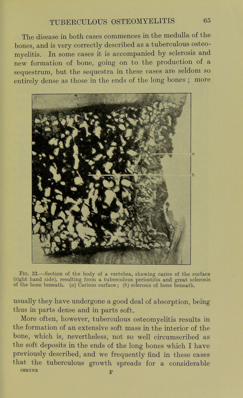 The disease in both cases commences in the medulla of the bones, and is very correctly described as a tuberculous osteo- myelitis. In some cases it is accompanied by sclerosis and new formation of bone, going on to the production of a sequestrum, but the sequestra in these cases are seldom so entirely dense as those in the ends of the long bones ; more Fig. 33.—Section of the body of a vertebra, showing caries of the surface (right hand side), resulting from a tuberculous periostitis and great sclerosis of the bone beneath, (a) Carious surface; (b) sclerosis of bone beneath. usually they have undergone a good deal of absorption, being thus in parts dense and in parts soft. More often, however, tuberculous osteomyelitis results in the formation of an extensive soft mass in the interior of the bone, which is, nevertheless, not so well circumscribed as the soft deposits in the ends of the long bones which I have previously described, and we frequently find in these cases that the tuberculous growth spreads for a considerable CHEYNE Ui