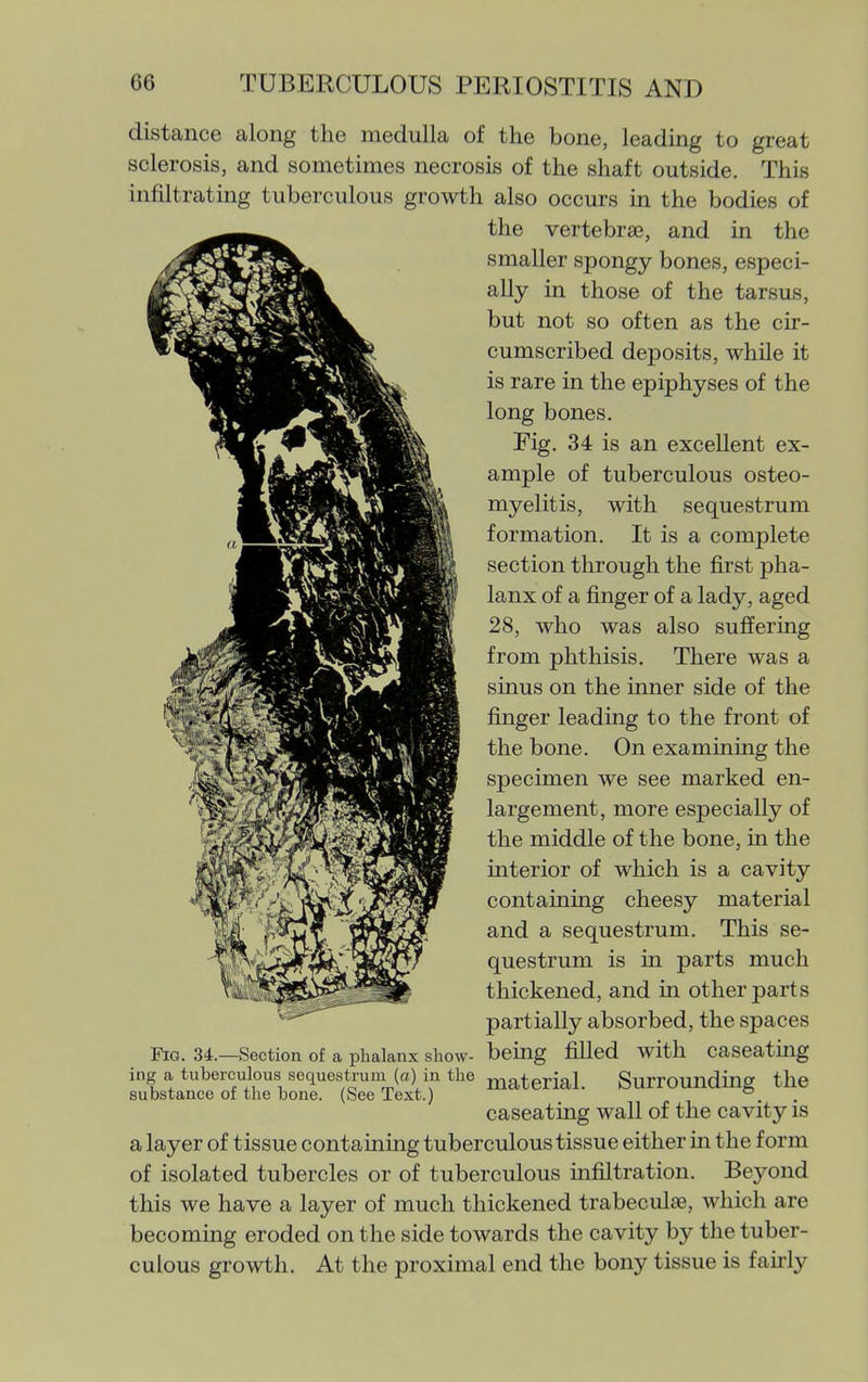 distance along the medulla of the bone, leading to great sclerosis, and sometimes necrosis of the shaft outside. This infiltrating tuberculous growth also occurs in the bodies of the vertebraj, and in the smaller spongy bones, especi- ally in those of the tarsus, but not so often as the cir- cumscribed deposits, while it is rare in the epiphyses of the long bones. Fig. 34 is an excellent ex- ample of tuberculous osteo- myelitis, with sequestrum formation. It is a complete section through the first pha- lanx of a finger of a lady, aged 28, who was also suffering from phthisis. There was a sinus on the inner side of the finger leading to the front of the bone. On examining the specimen we see marked en- largement, more especially of the middle of the bone, in the interior of which is a cavity containing cheesy material and a sequestrum. This se- questrum is in parts much thickened, and in other parts partially absorbed, the spaces Fig. 34.—Section of a phalanx show- being filled with caseating ing a tuberculous sequestrum (a) in the material. Surrounding the substance of the bone. (See Text.) ° caseating wall of the cavity is a layer of tissue containing tuberculous tissue either in the form of isolated tubercles or of tuberculous infiltration. Beyond this we have a layer of much thickened trabeculse, which are becoming eroded on the side towards the cavity by the tuber- culous growth. At the proximal end the bony tissue is fairly